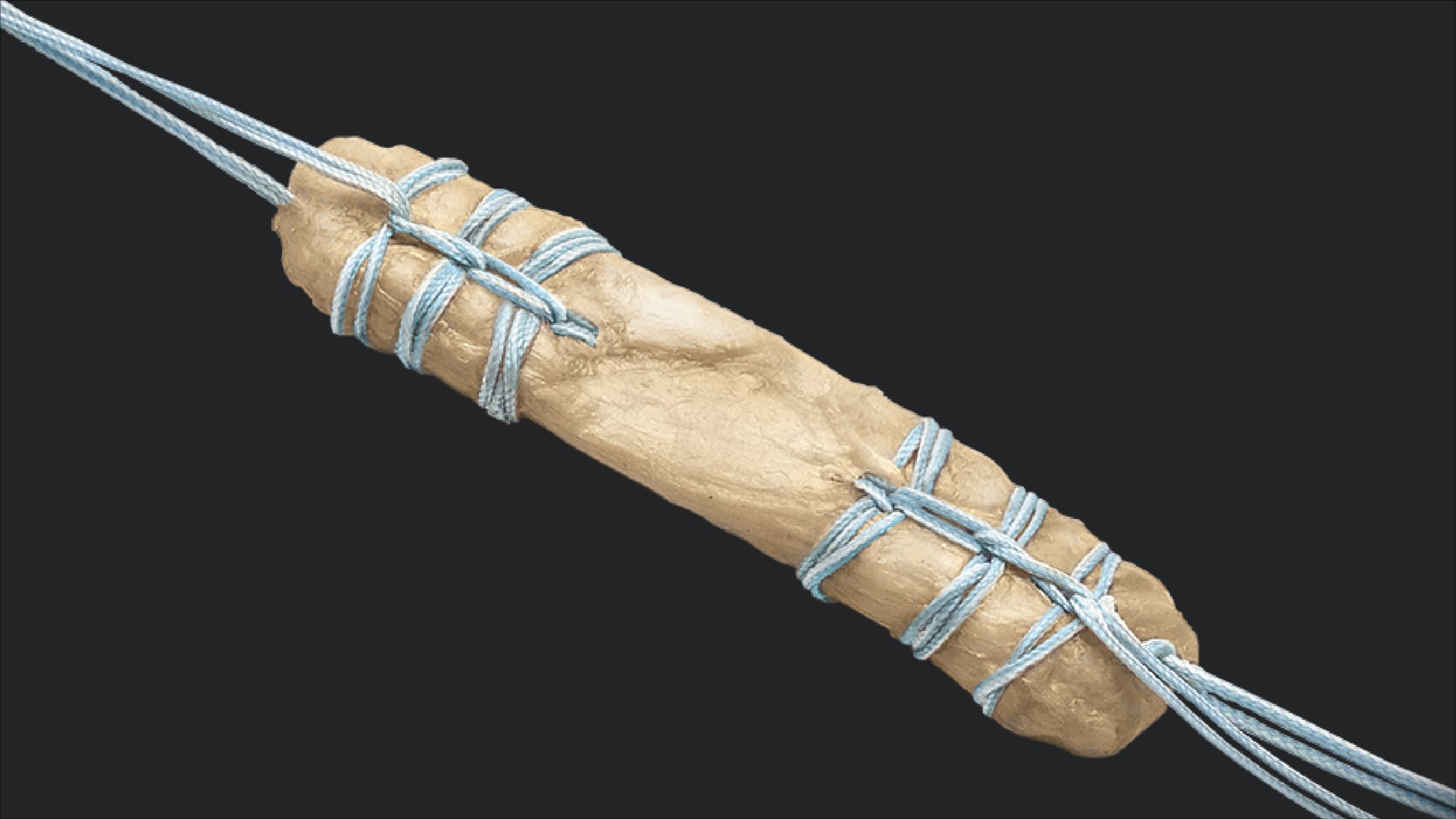 ACL Reconstruction Using QuadLink™ Presutured Allograft and TightRope® II Implants
