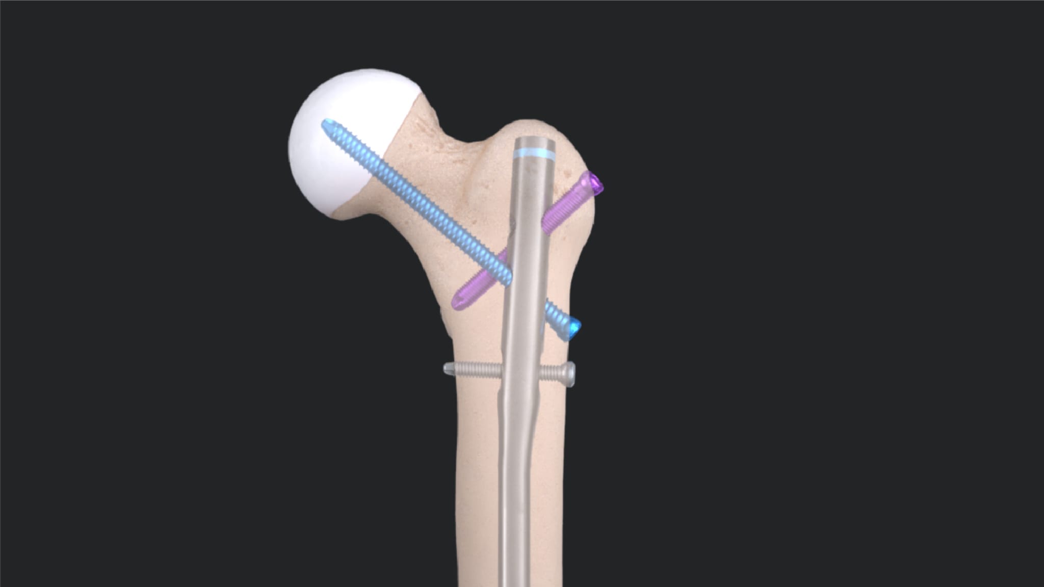 Antegrade Femoral Nail System Surgical Technique