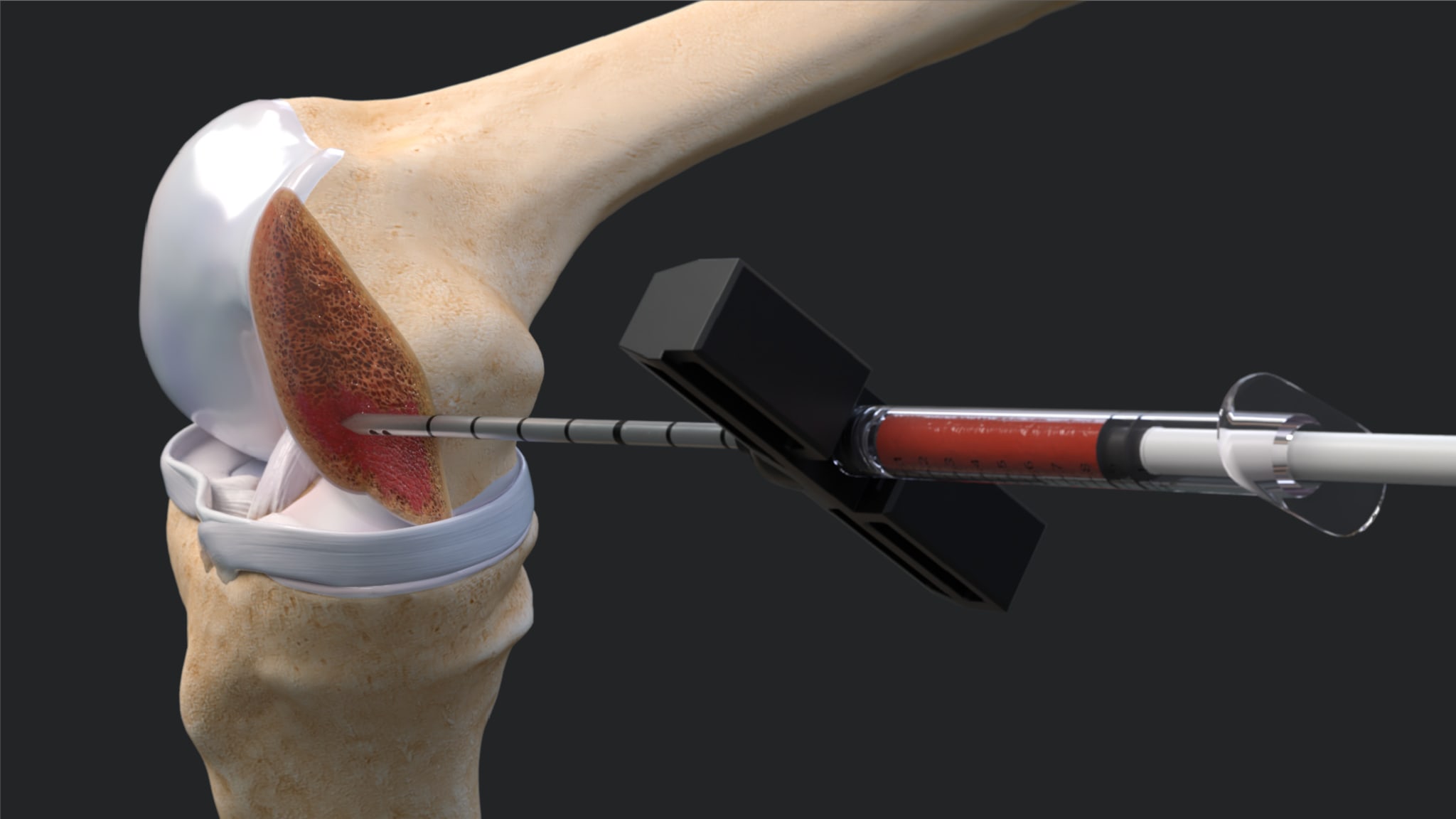 IntraOsseous BioPlasty® Technique for Bone Marrow Lesions of the Knee—Direct Approach