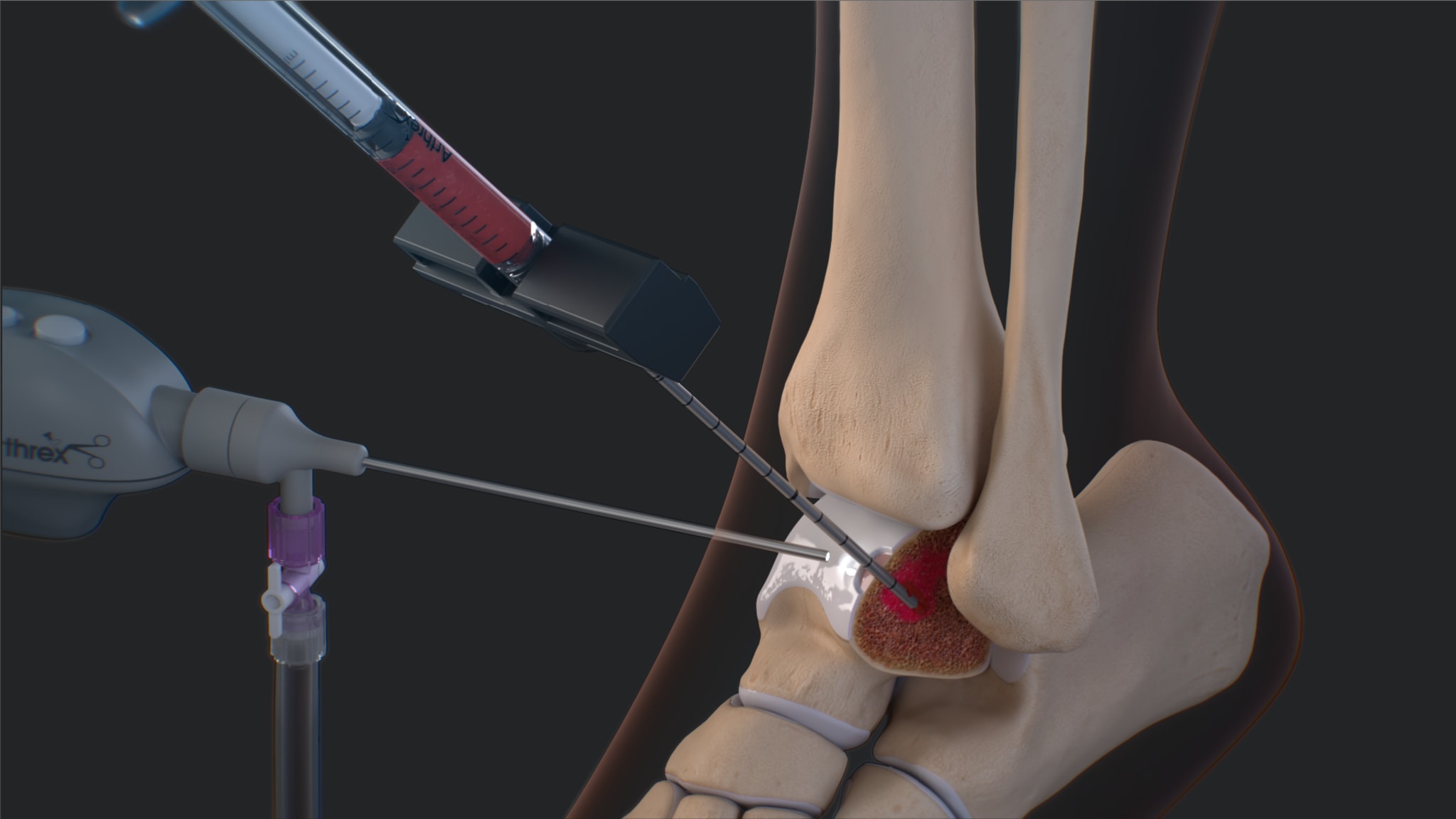 IntraOsseous BioPlasty® (IOBP) Technique for Treatment of Bone Marrow Lesions of the Talus