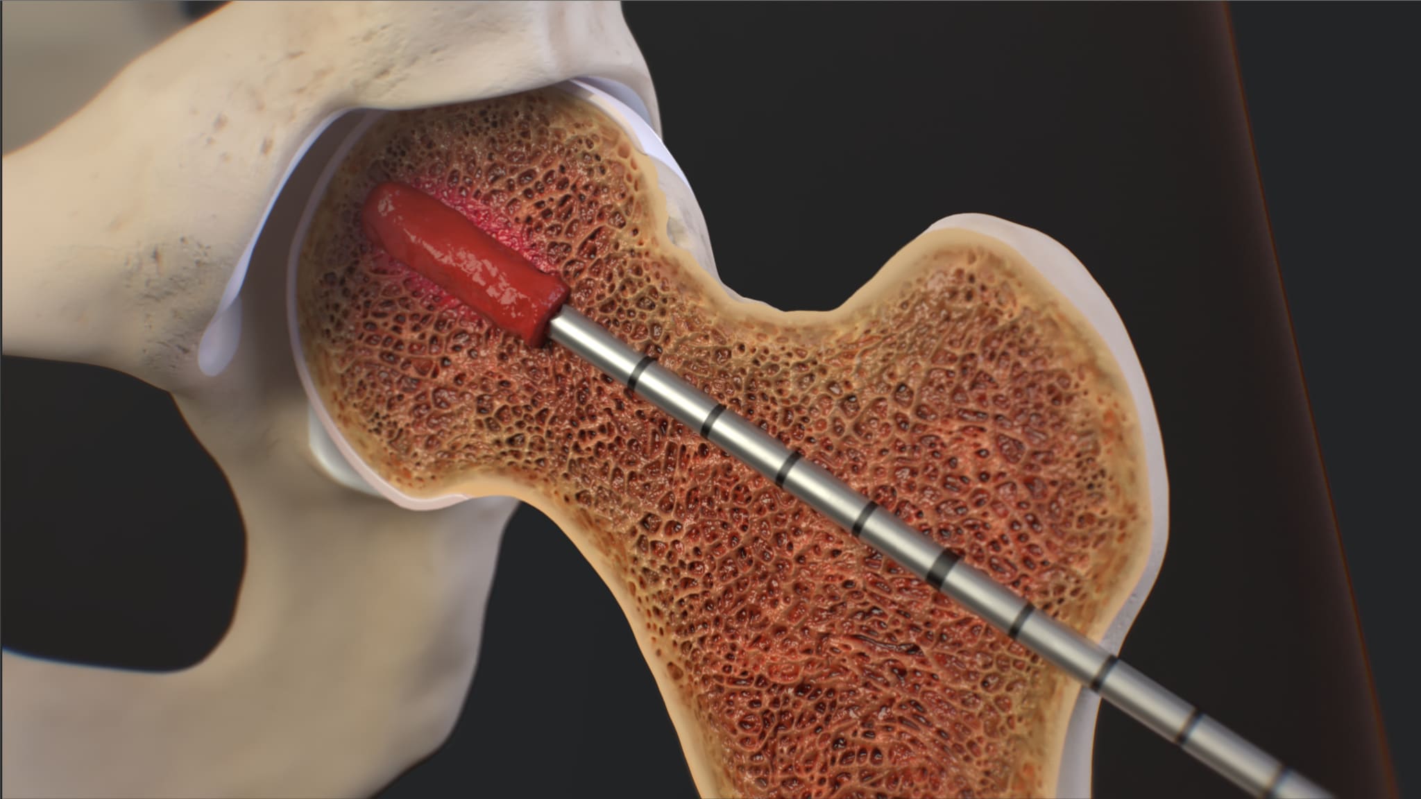 IntraOsseous BioPlasty® (IOBP®) Surgical Technique for a Bone Marrow Lesion of the Hip