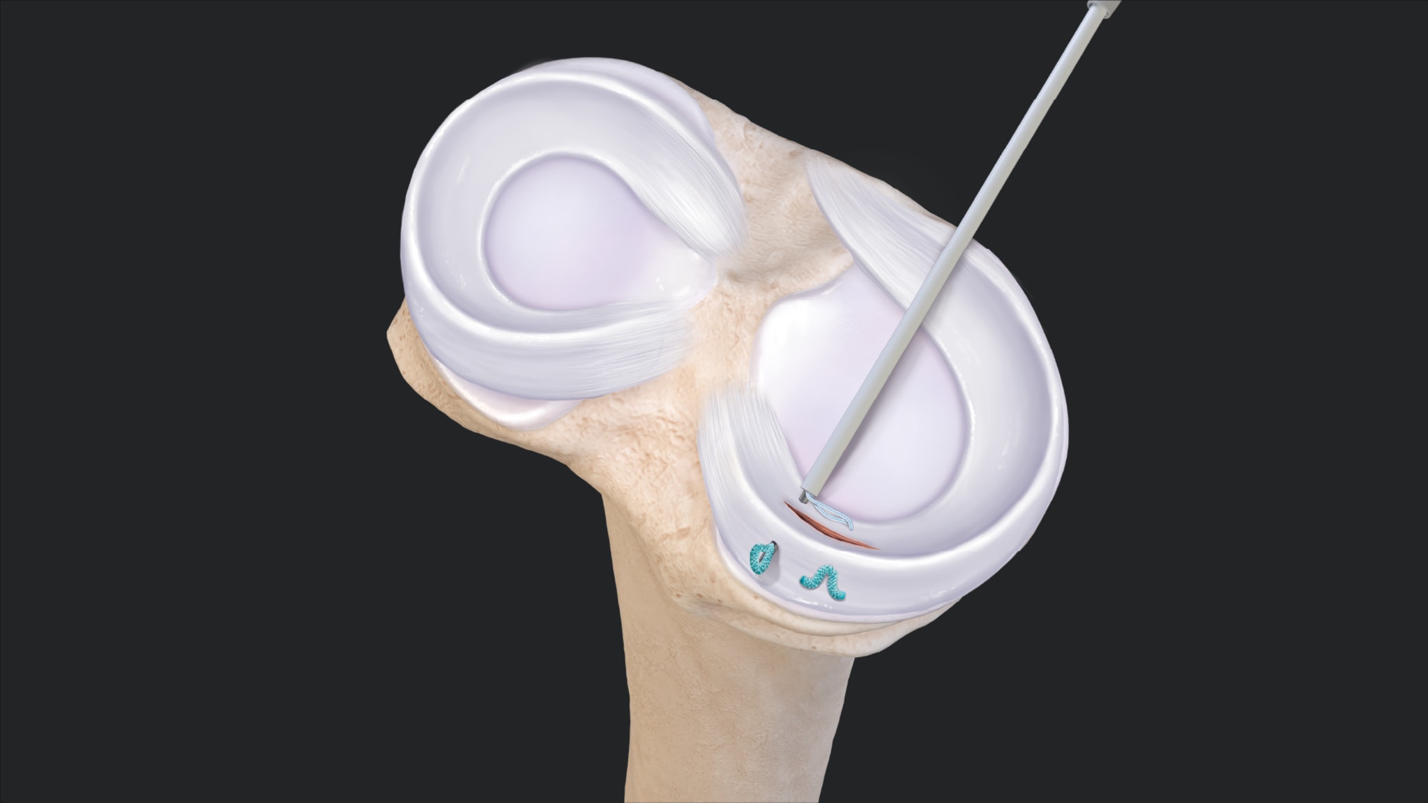 FiberStitch™ Implant System: Arthroscopic Demonstration
