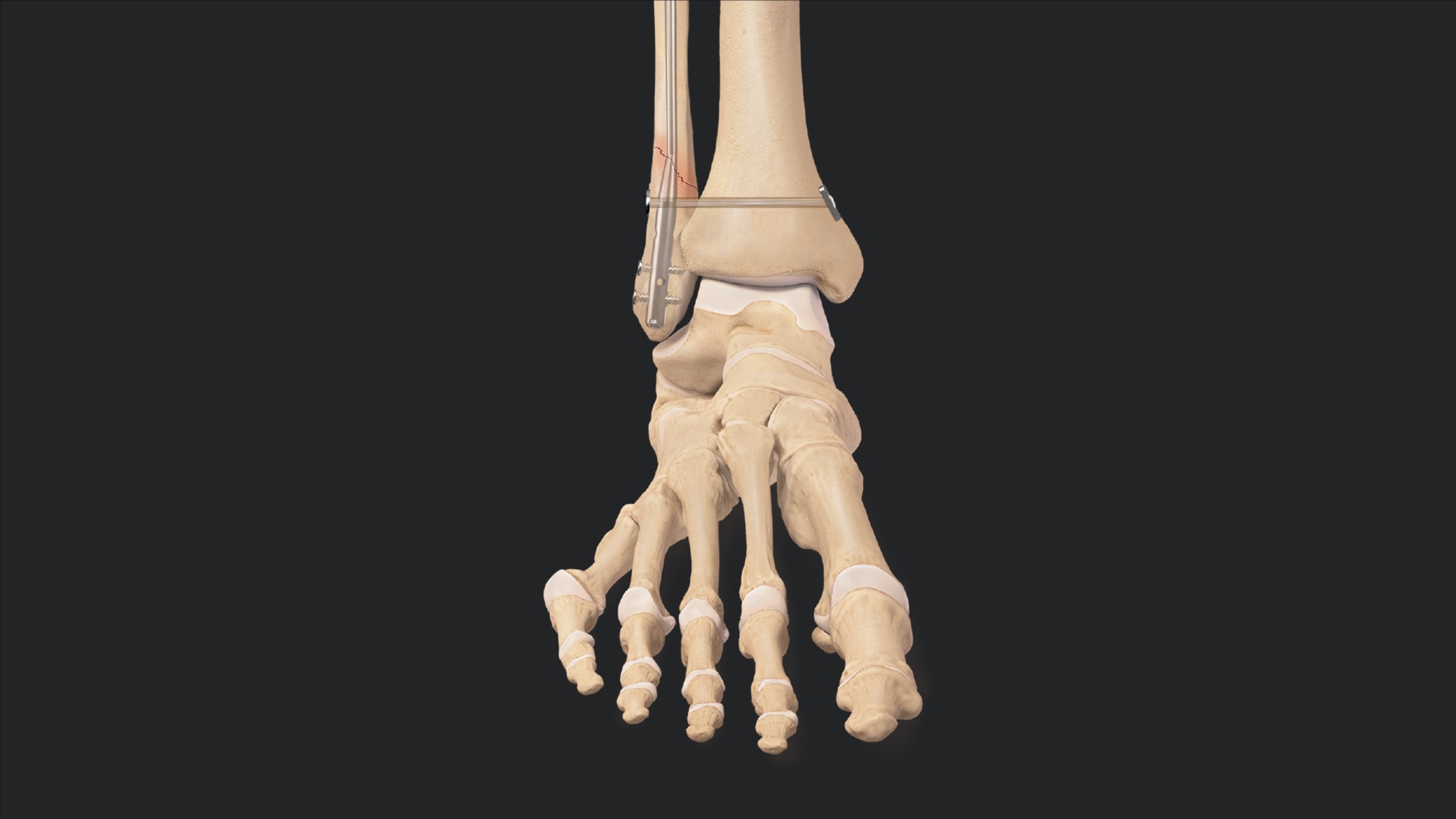 Ankle Fracture Revision Using a FibuLock® Nail and TightRope® XP Implants