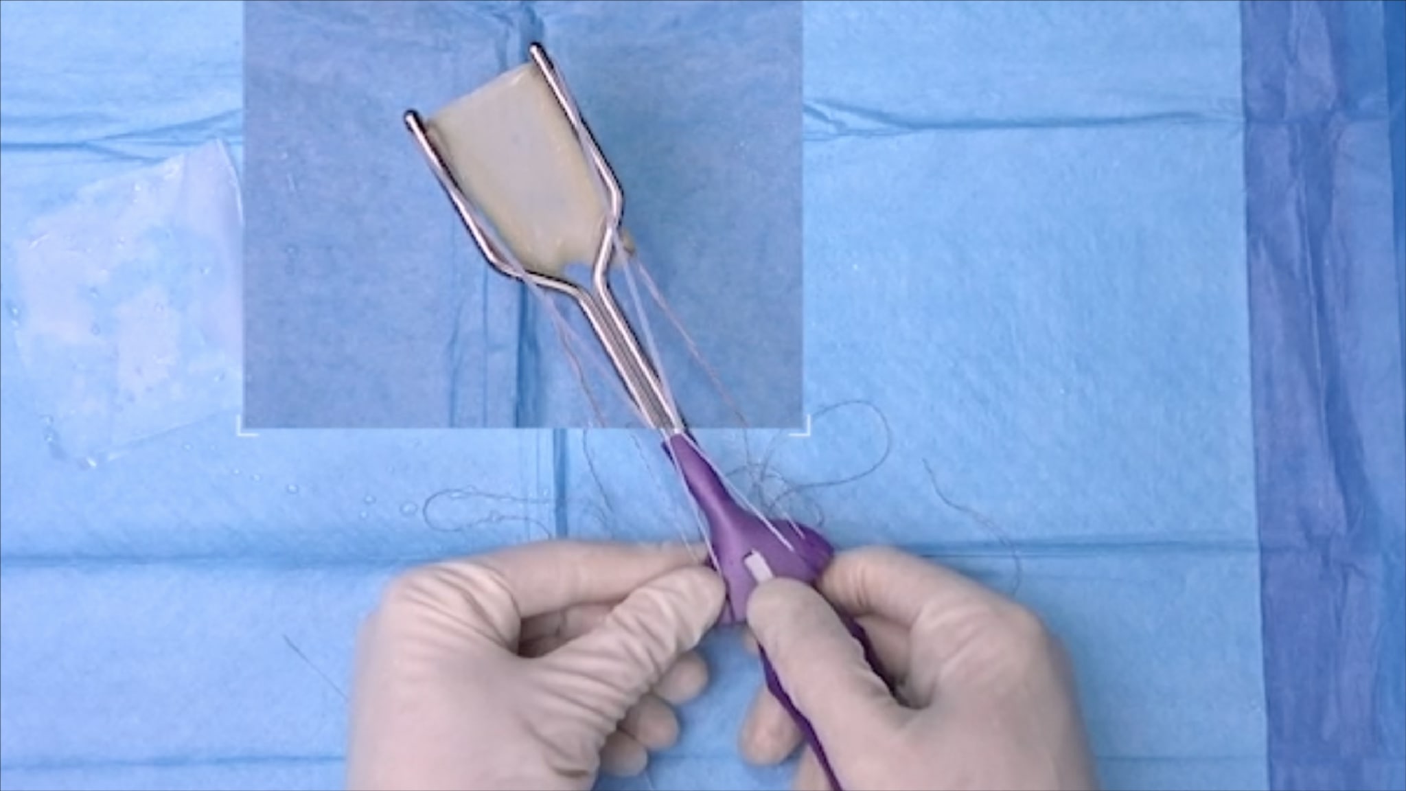 CuffMend™ Rotator Cuff Augmentation System