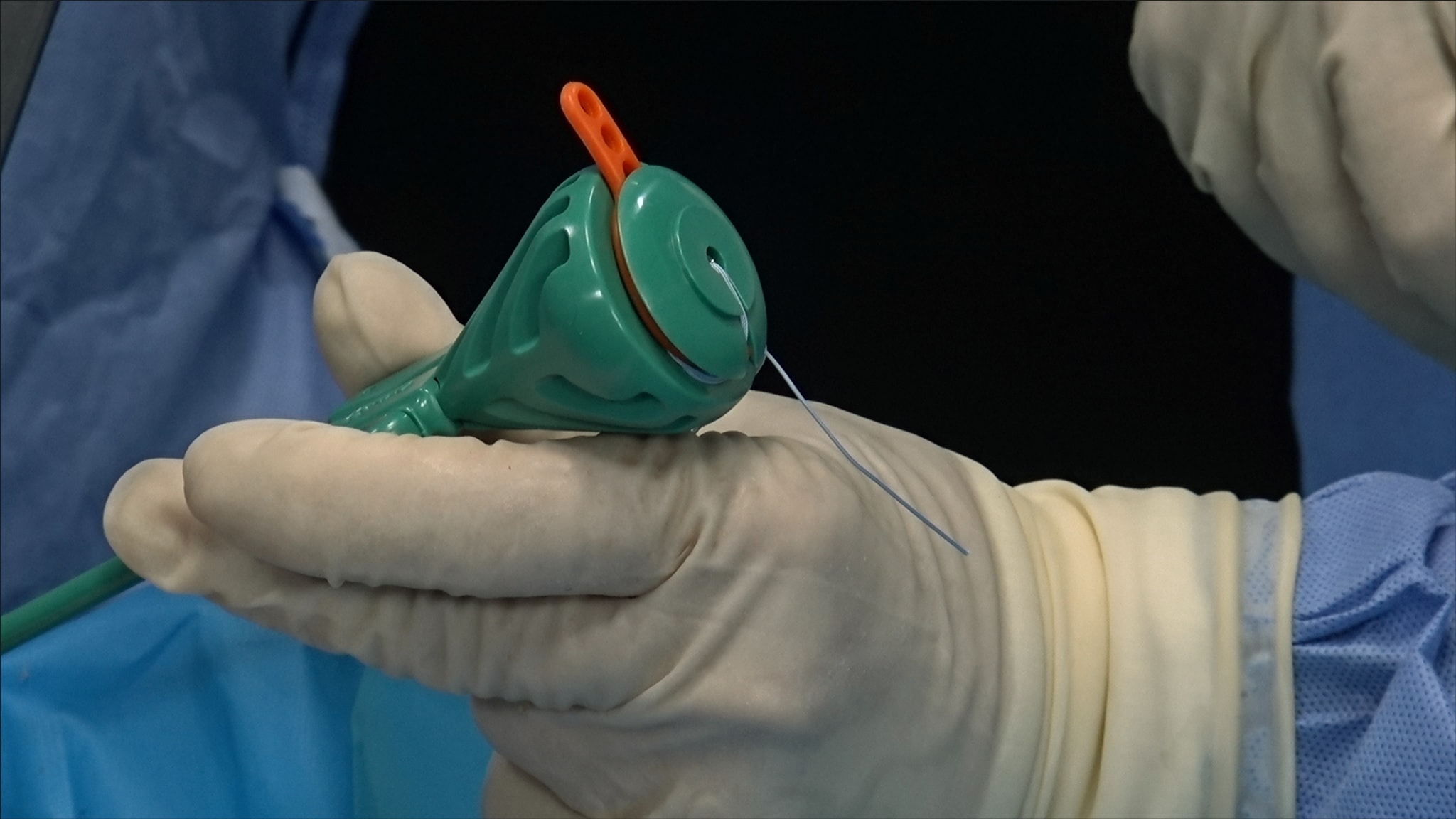 Open Proximal Hamstring Tendon Repair Using a Knotless SpeedBridge™ Construct