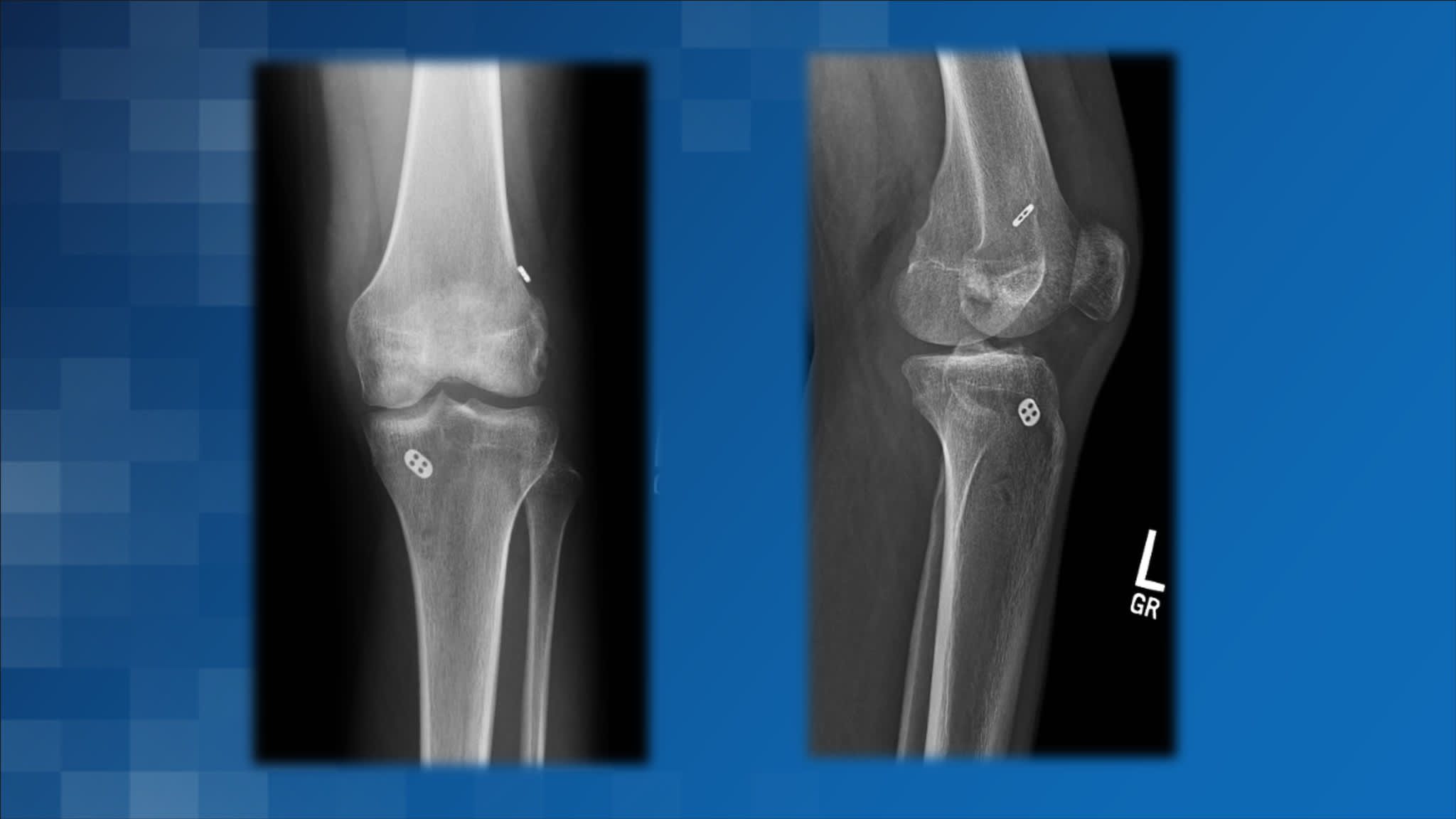 Alternatives in Multiligament Treatment