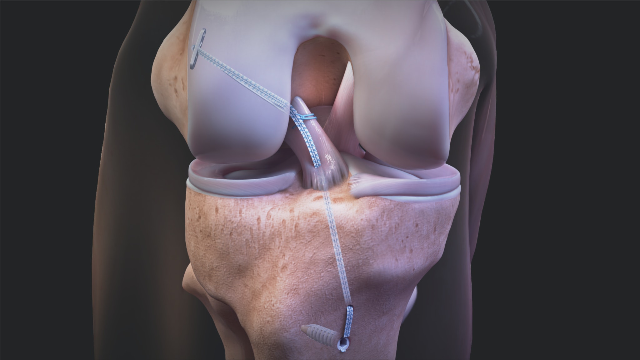 ACL Repair TightRope® Surgical Technique Animation