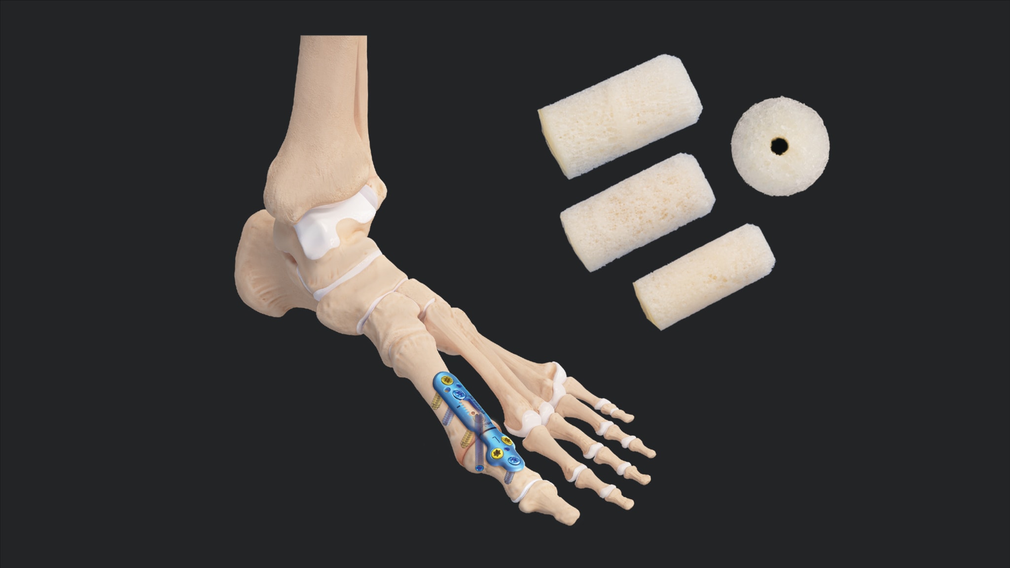 1st MTP Revision Using a Cannulated Revision Bone Dowel and Augmented With ArthroCell™ Viable Bone Matrix