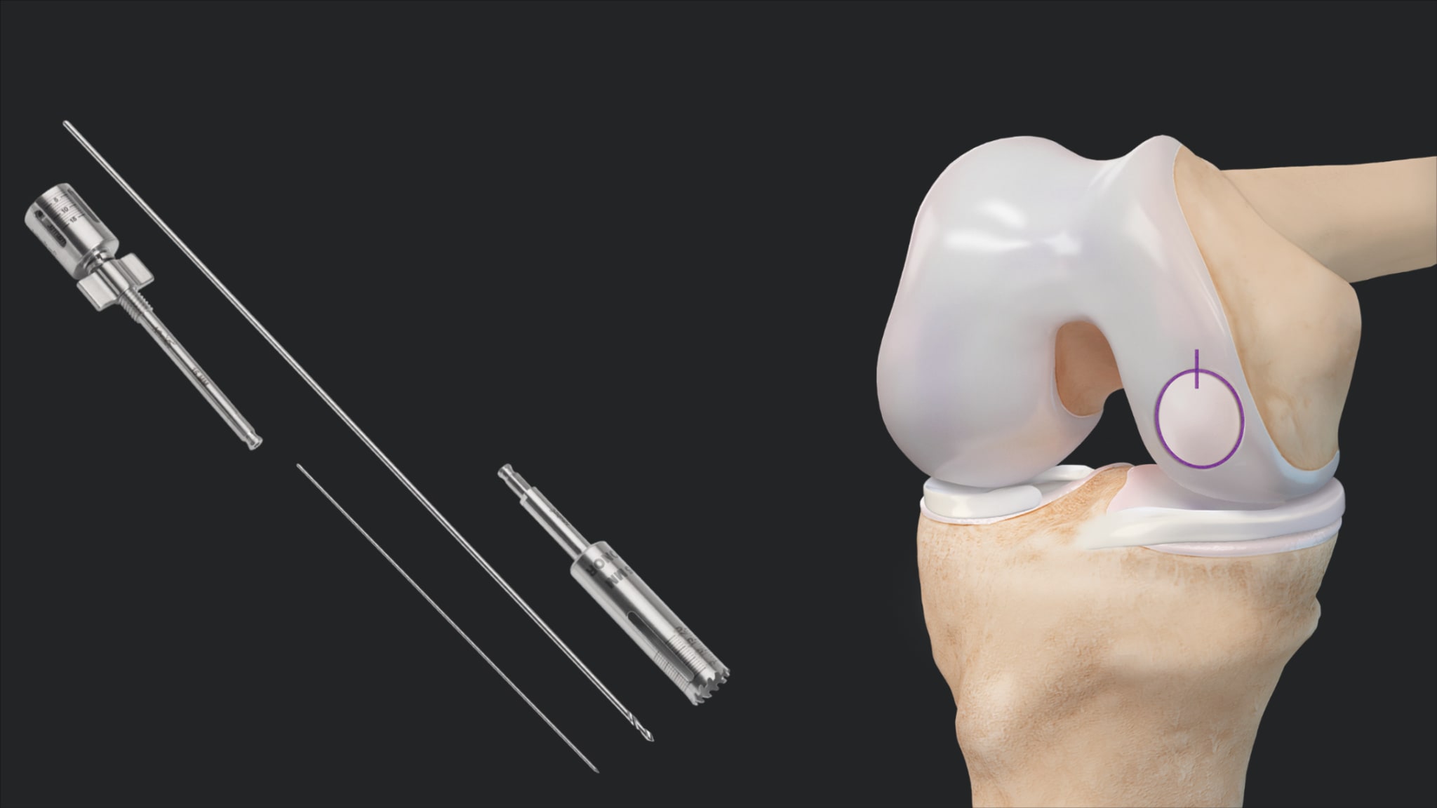 Treatment of a Femoral Condyle Cartilage Defect Using the Allograft OATS® Disposable Kit