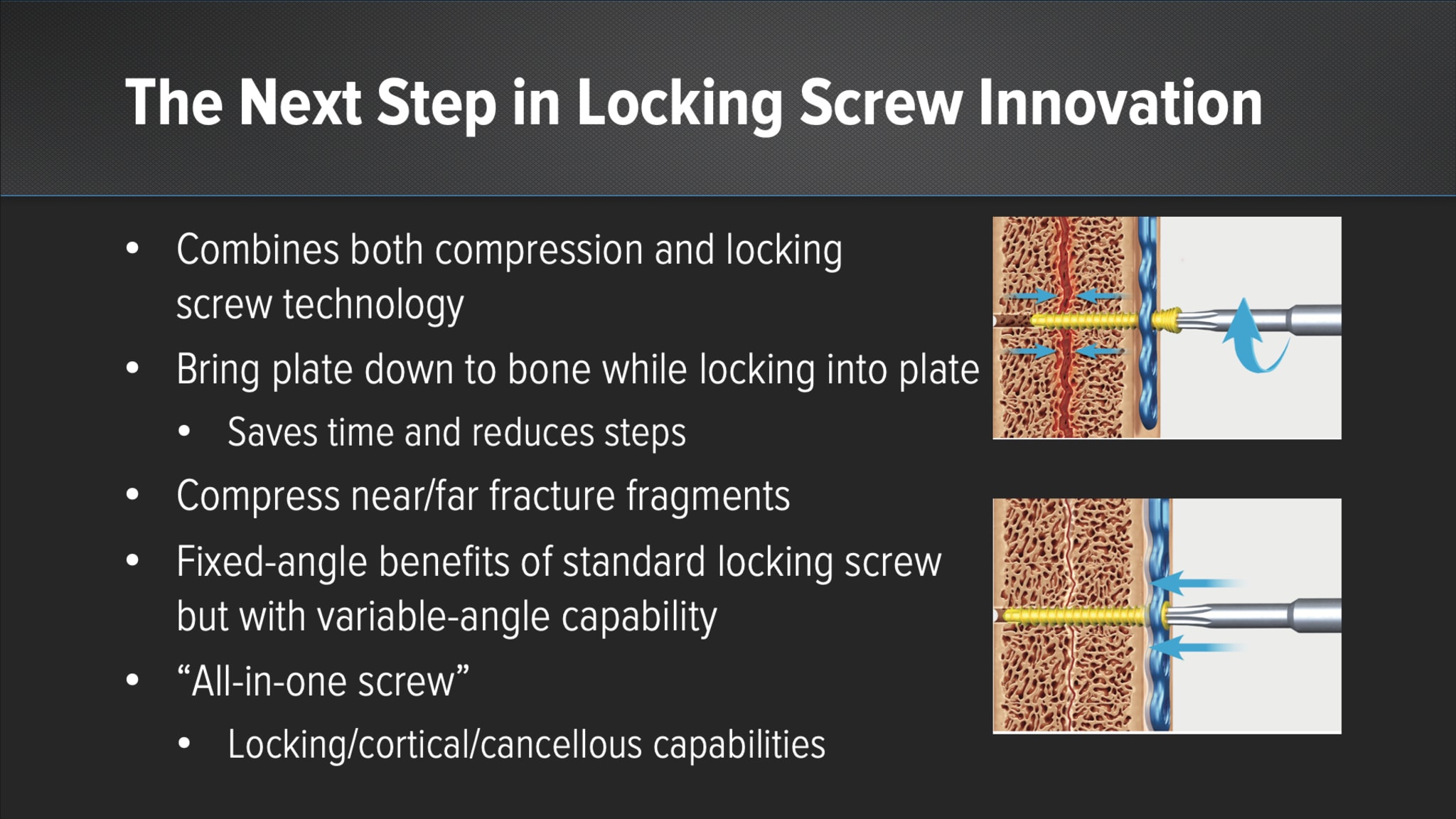 Calcaneus Fractures Using KreuLock™ Locking Compression Screws