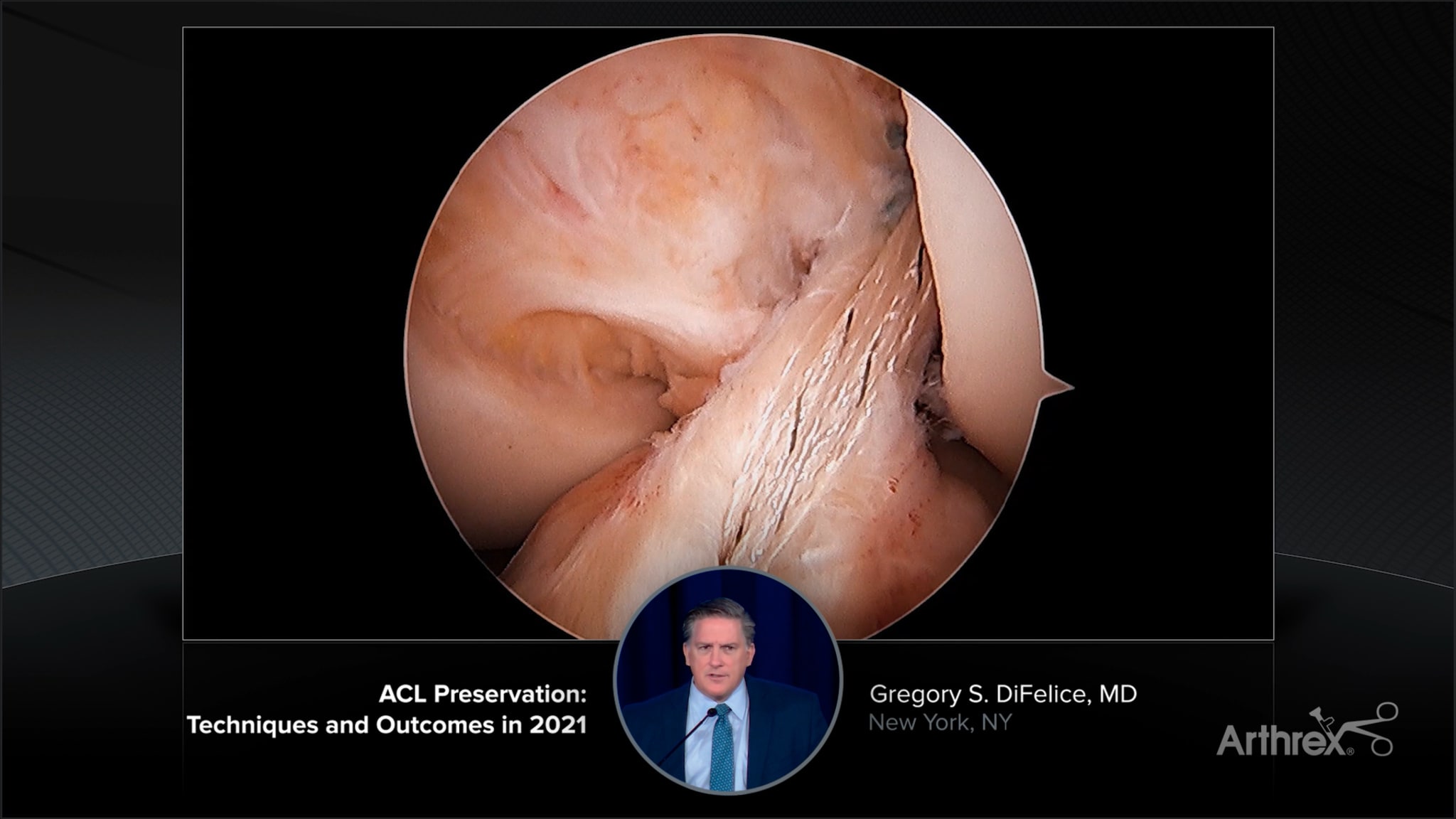 ACL Preservation: Techniques and Outcomes