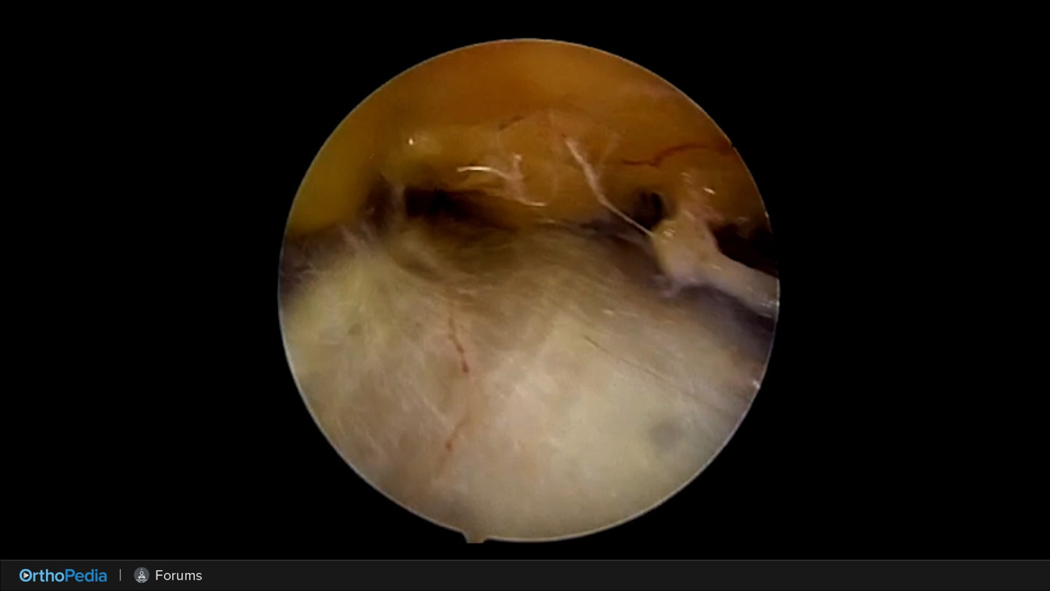 OTIF: Quad Tendon ACL Graft—A Decade of Experience