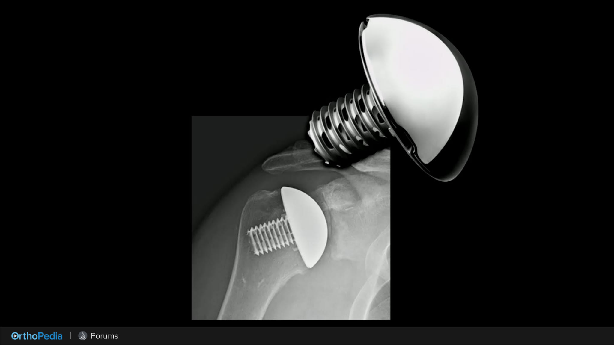 OTIF: The US Experience in Stemless Arthroplasty