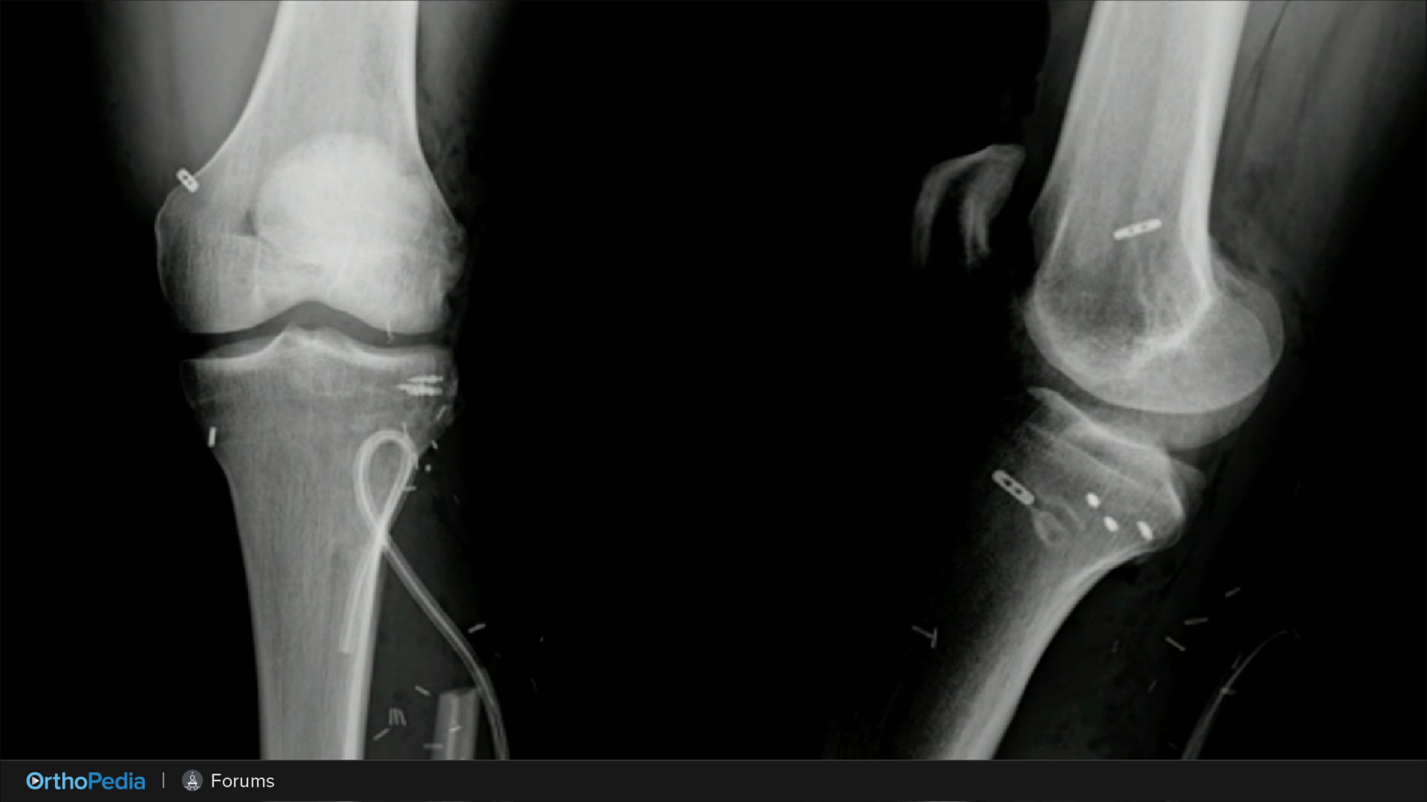 OTIF: Long-Term Outcomes and New Trends in High Tibial Osteotomy (HTO)