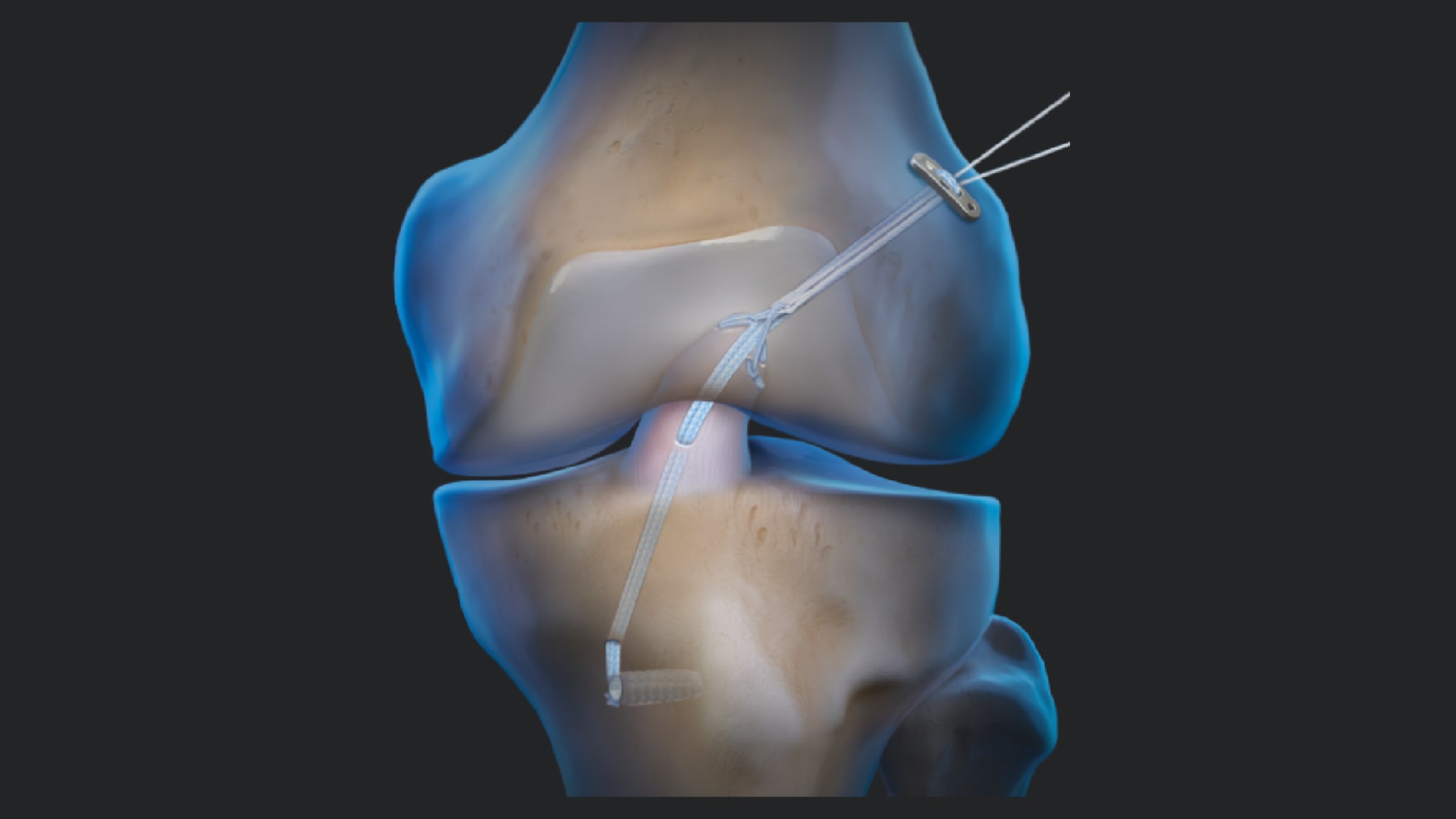 ACL Tears: Literature Review on Primary ACL Repair