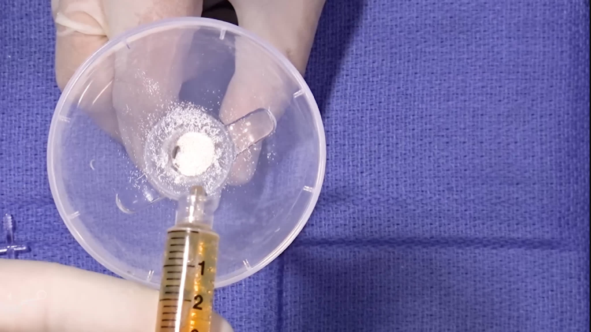 AutoCart™ Procedure for an Articular Cartilage Lesion of the Condoyle