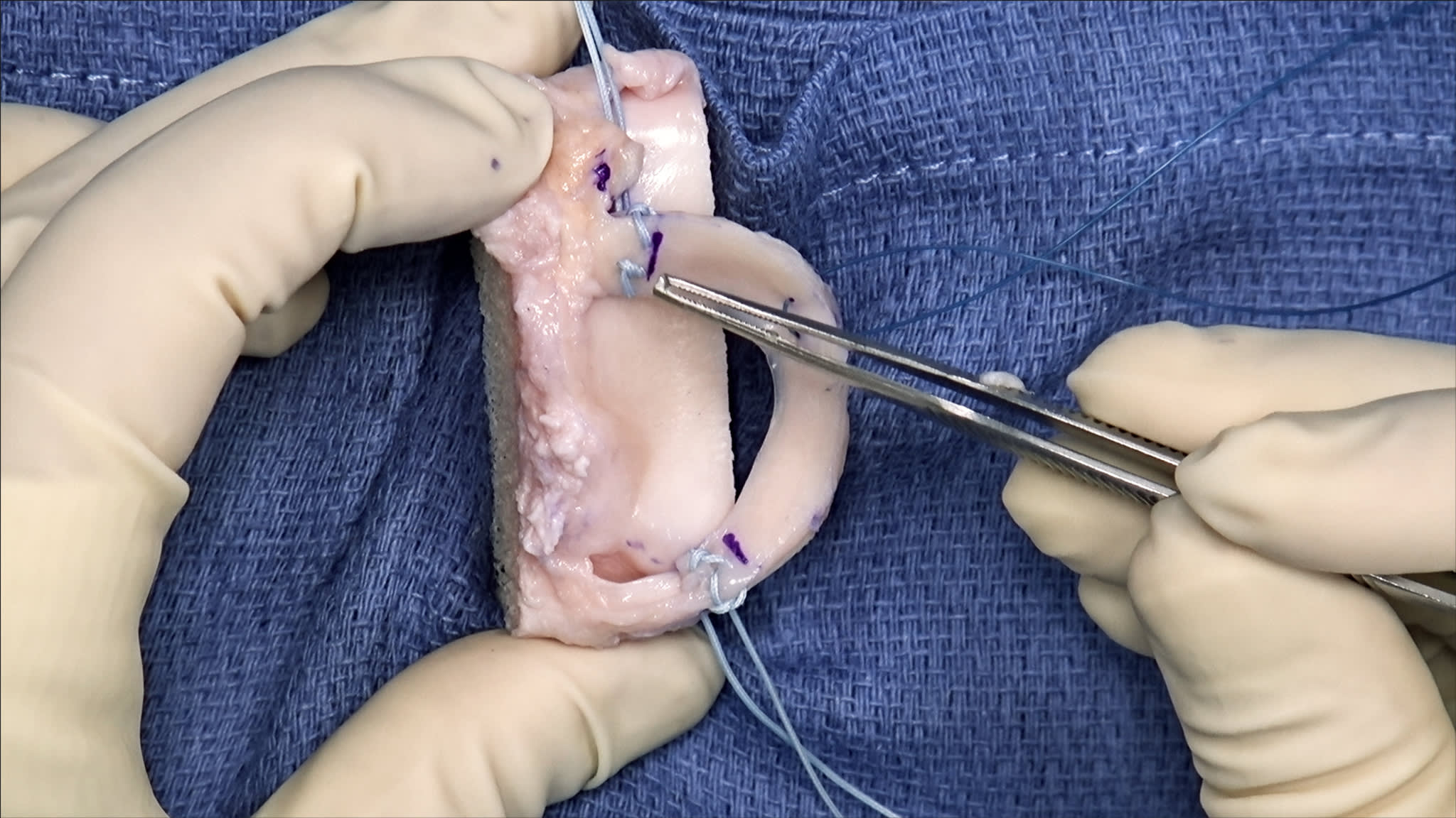 Soft-Tissue Meniscal Allograft Transplantation Technique