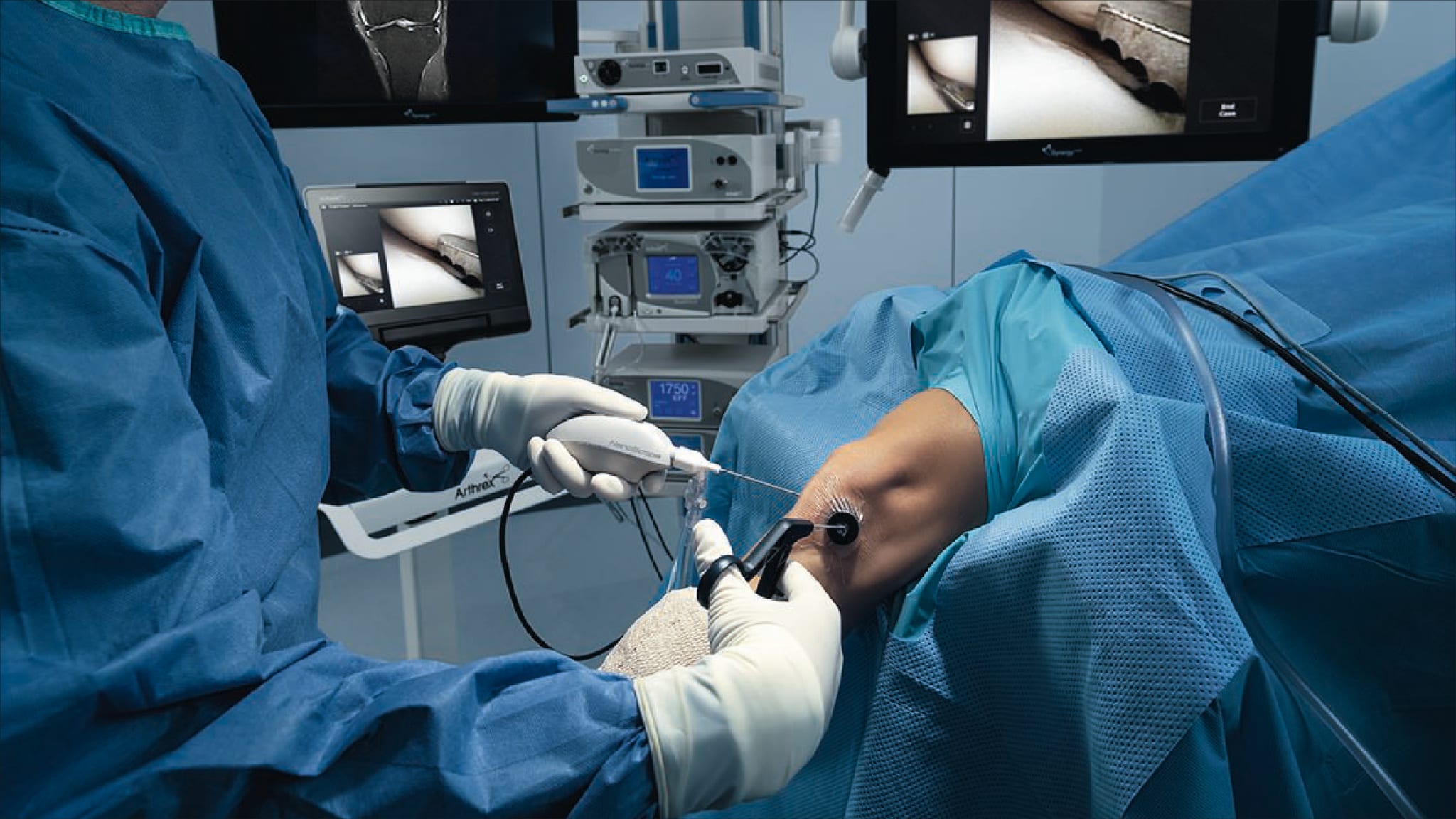 Incisionless Partial Medial Meniscectomy With the NanoScope™ Operative Arthroscopy System