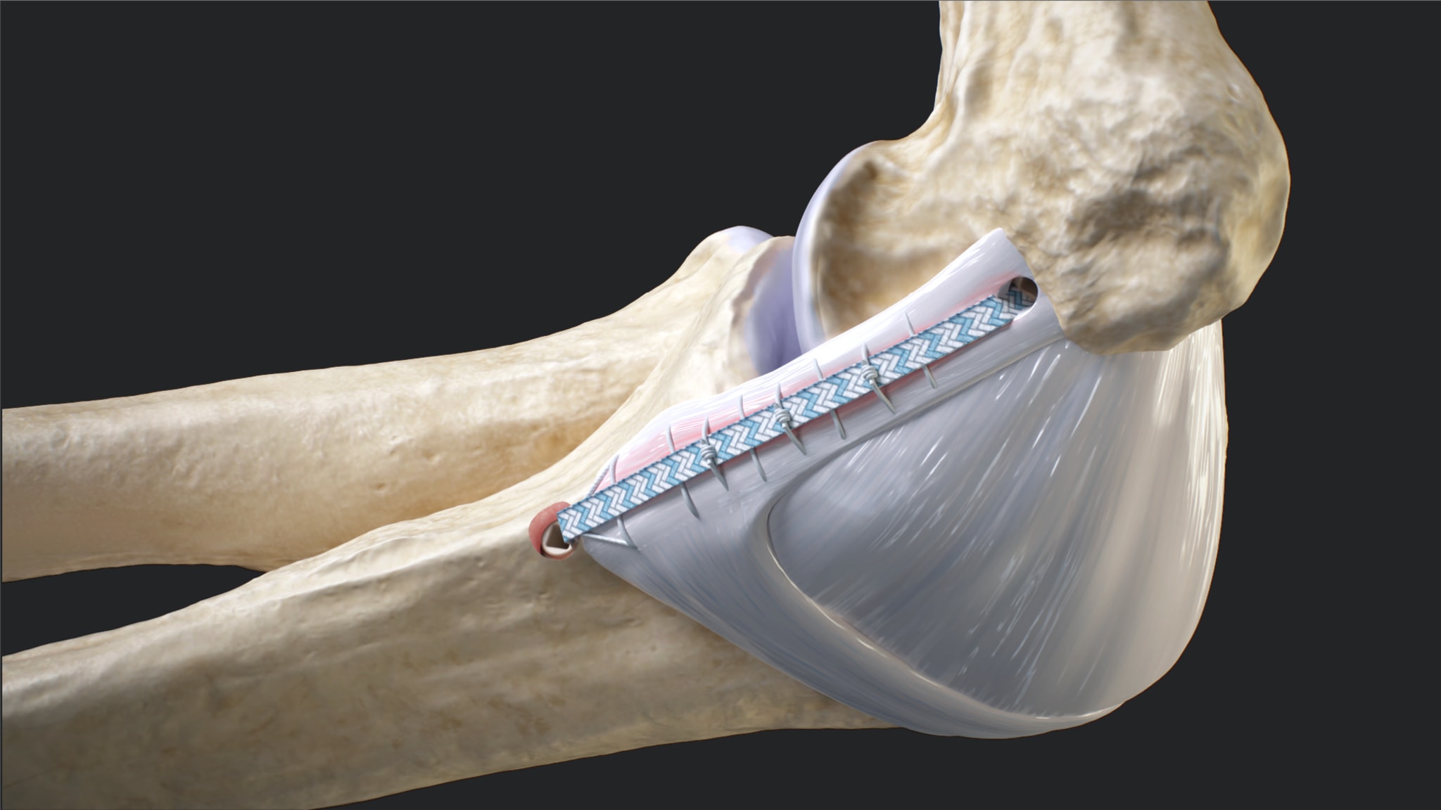 MUCL Repair With the InternalBrace™ System
