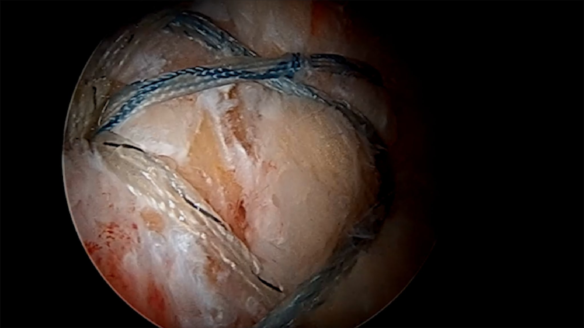 Cowboy Way Advanced Shoulder Arthroscopy: Double-Row Repair—Why and How?
