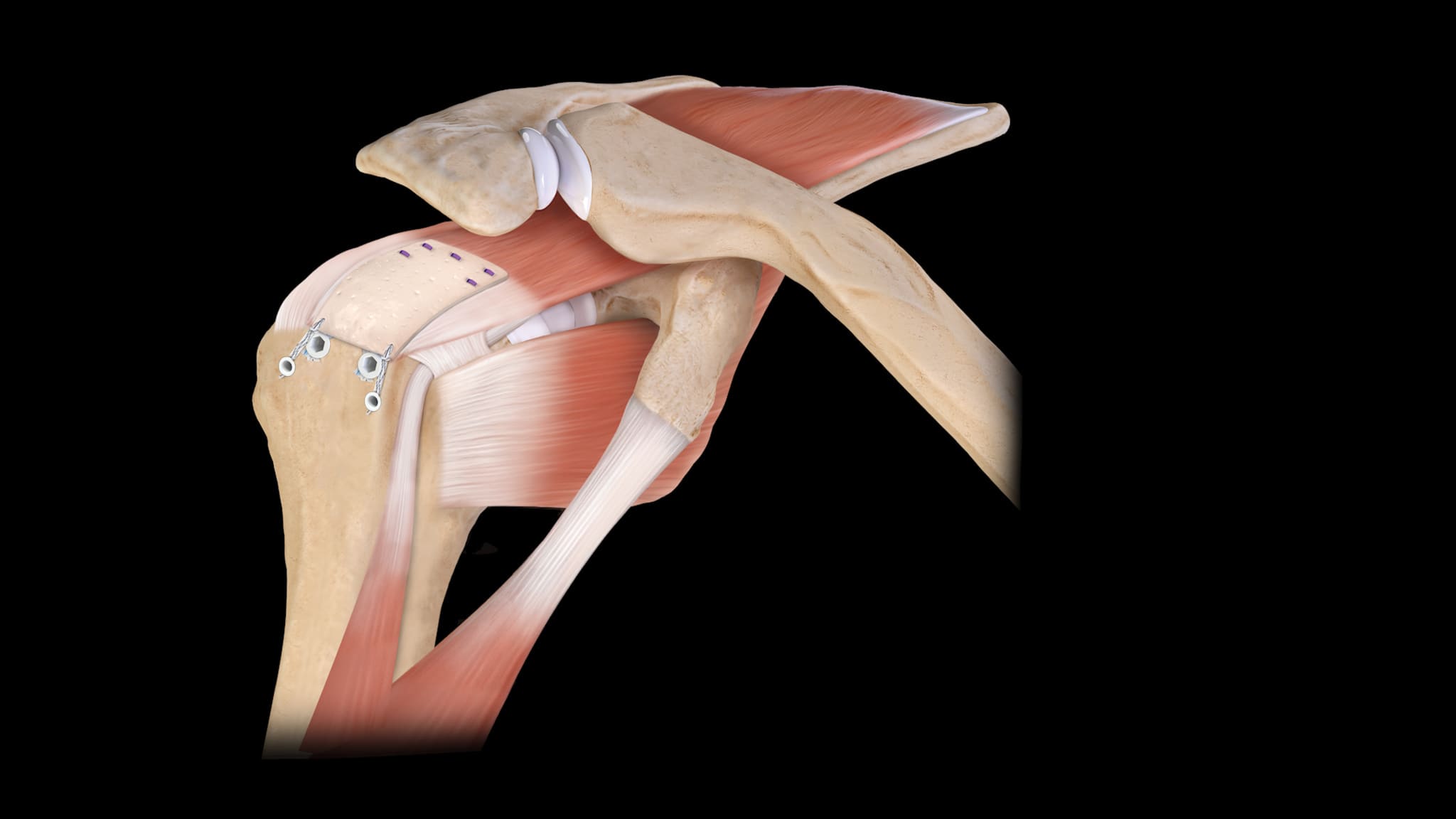 CuffMend™ Rotator Cuff Augmentation for Partial-Thickness Rotator Cuff Tears