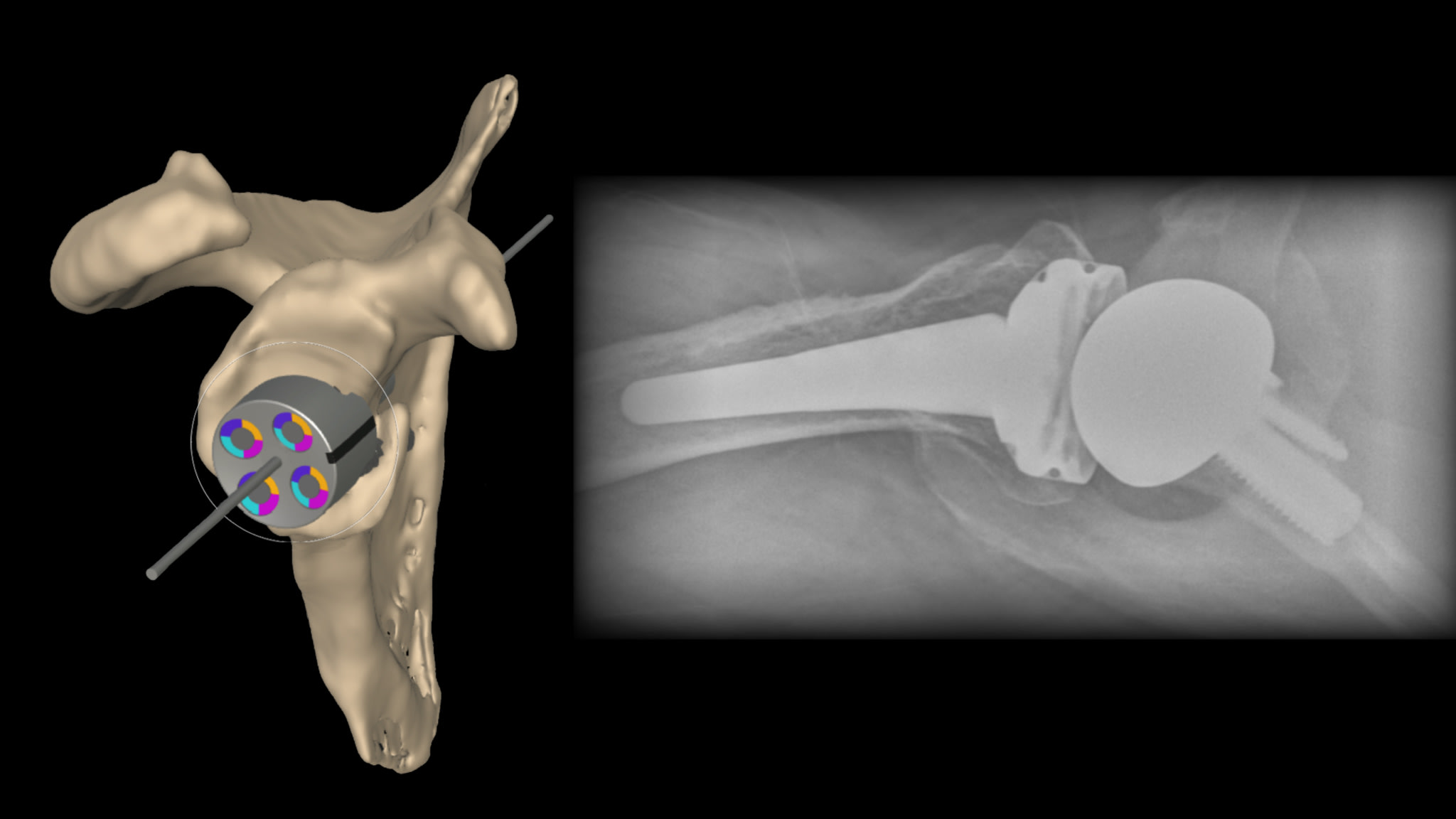 Managing Anterior Glenoid Bone Loss With the Univers Revers™ Augmented Modular Glenoid System (MGS)