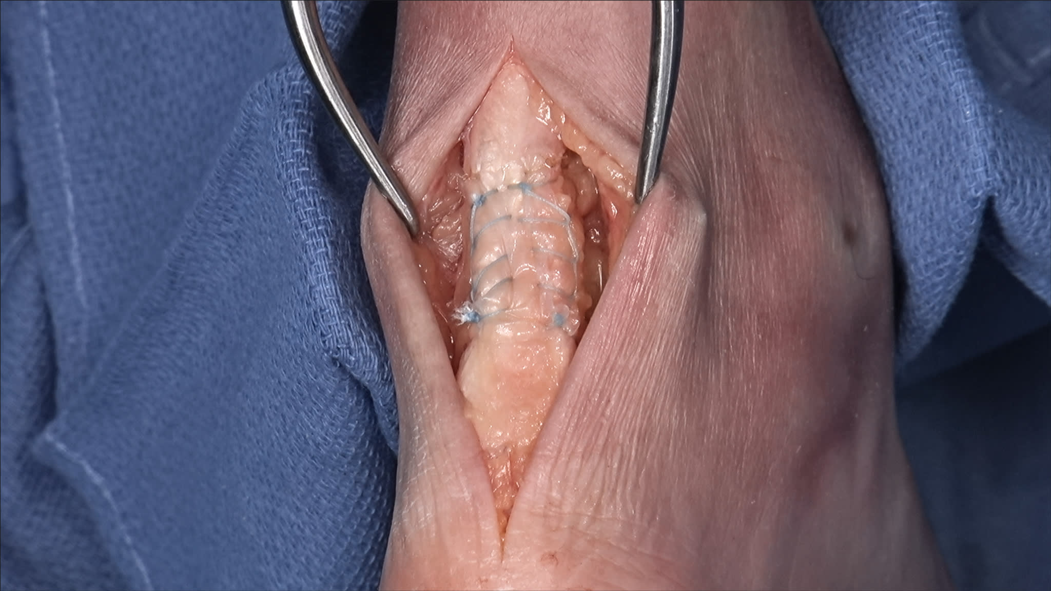 CentaFlex™ Human Placental Matrix for Achilles Tendon Repair