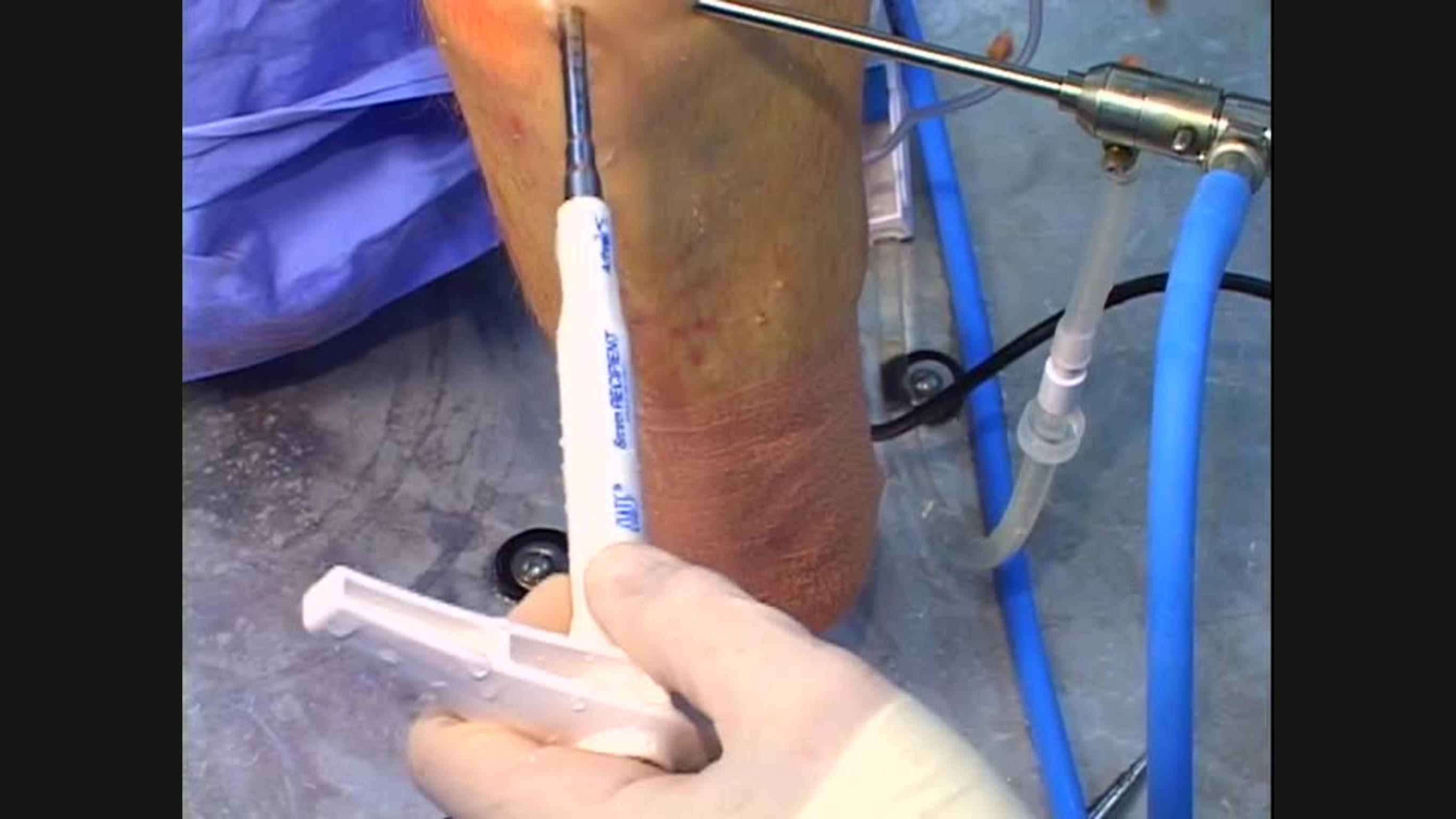Cadaveric Demonstration of the Single Use Osteochondral Autograft Transfer System