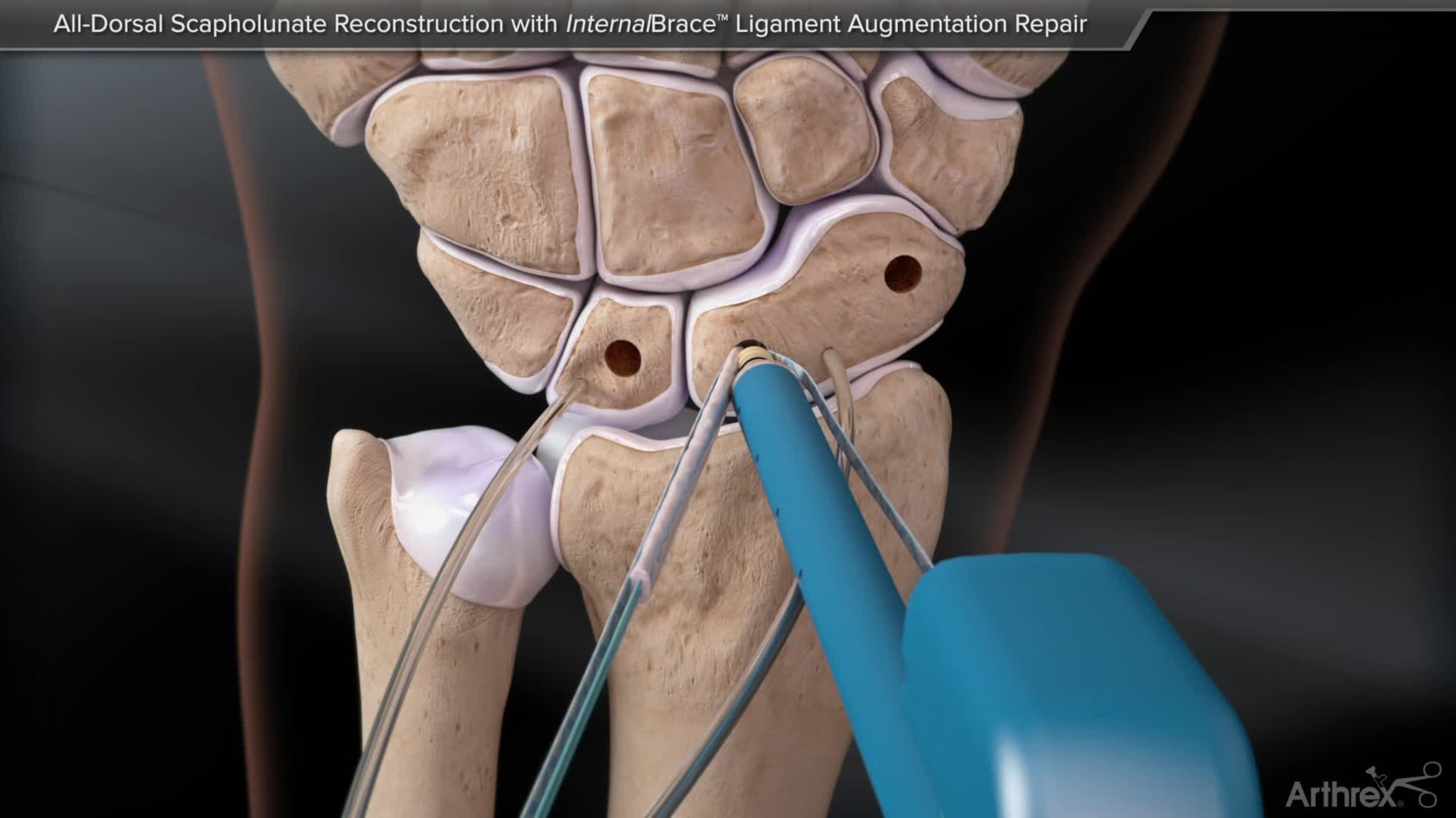 All-Dorsal Scapholunate Reconstruction With InternalBrace™ Ligament Augmentation Repair