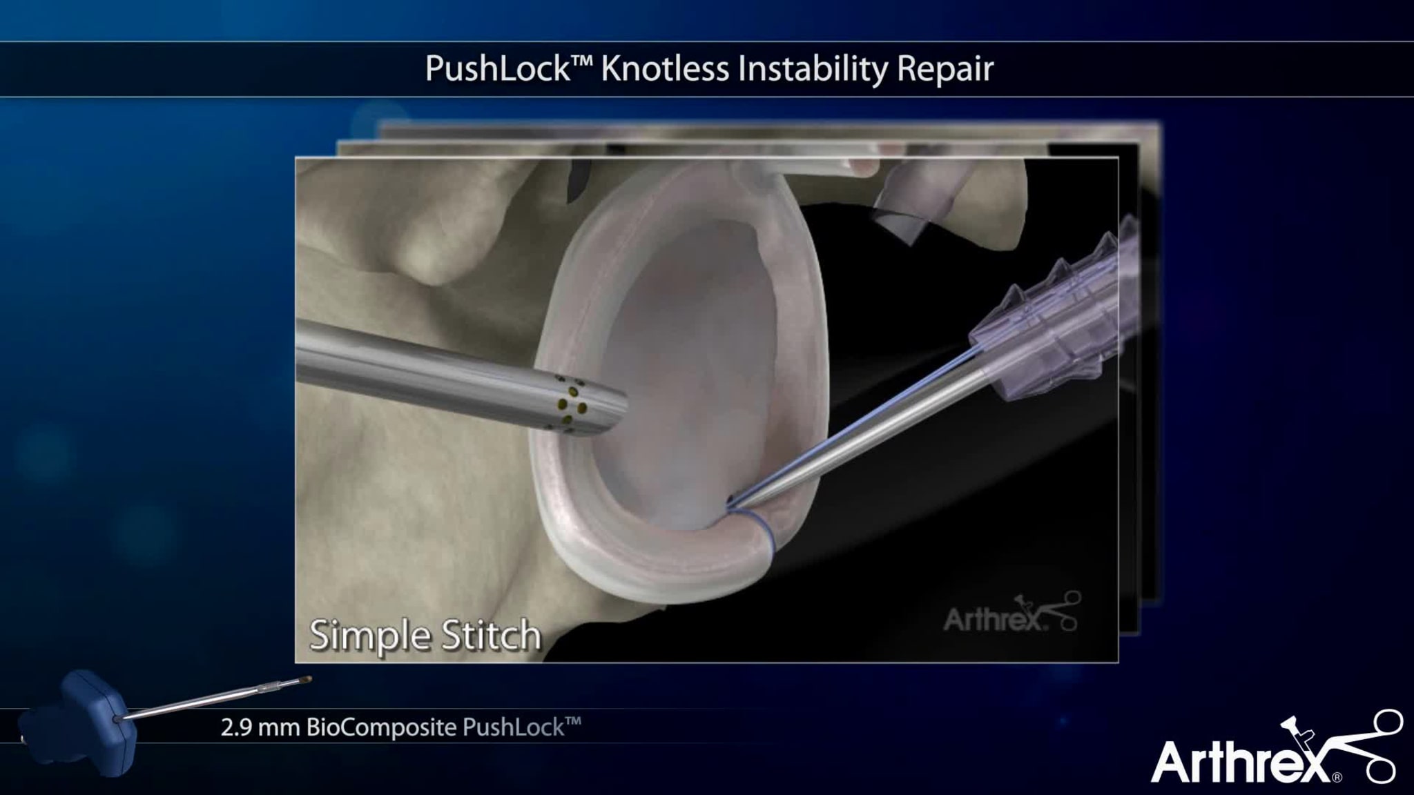 PushLock® Knotless Instability Repair