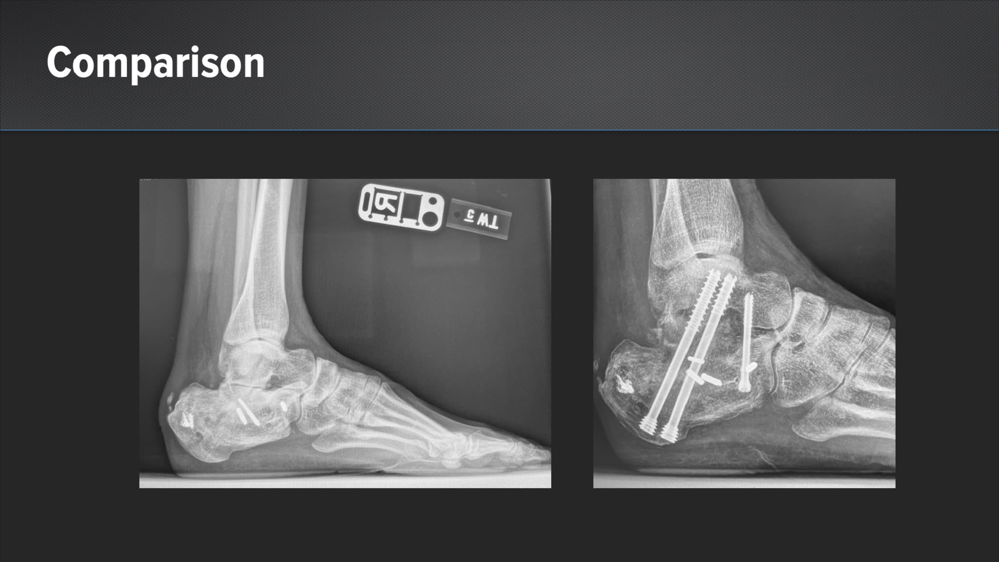 Bone Block Subtalar Arthrodesis With AlloSync™ Anatomic Reconstruction Wedge