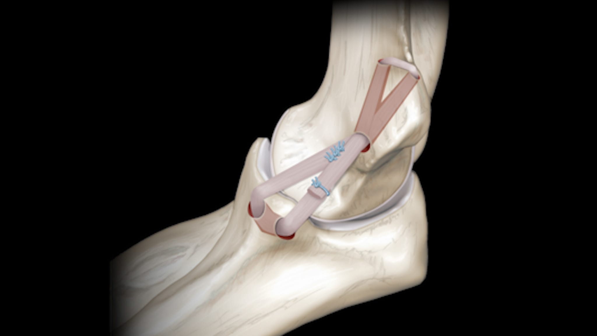 Dual-Docking 4-Ply Elbow Ulnar Collateral Ligament Reconstruction With InternalBrace™ Repair