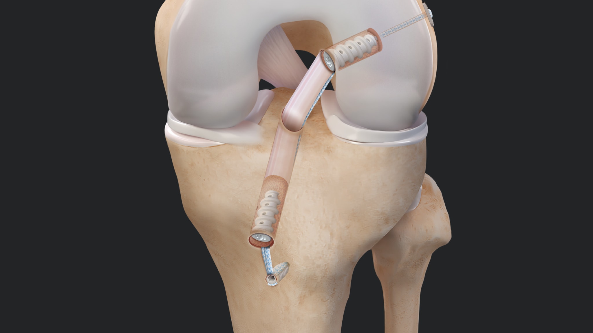 BTB ACL Reconstruction Using BioComposite FastThread™ Interference Screws and the FiberTape® Button for the InternalBrace™ Technique