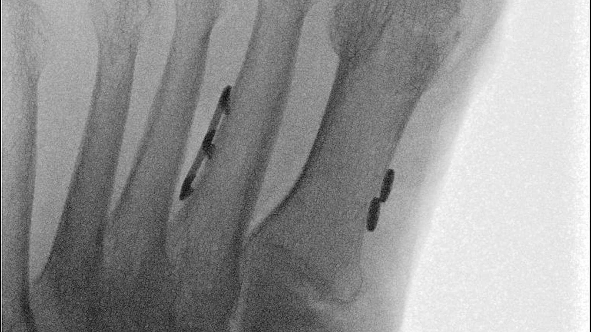 Adjunct Fixation With the Knotless Mini TightRope® System for Hallux Valgus Correction