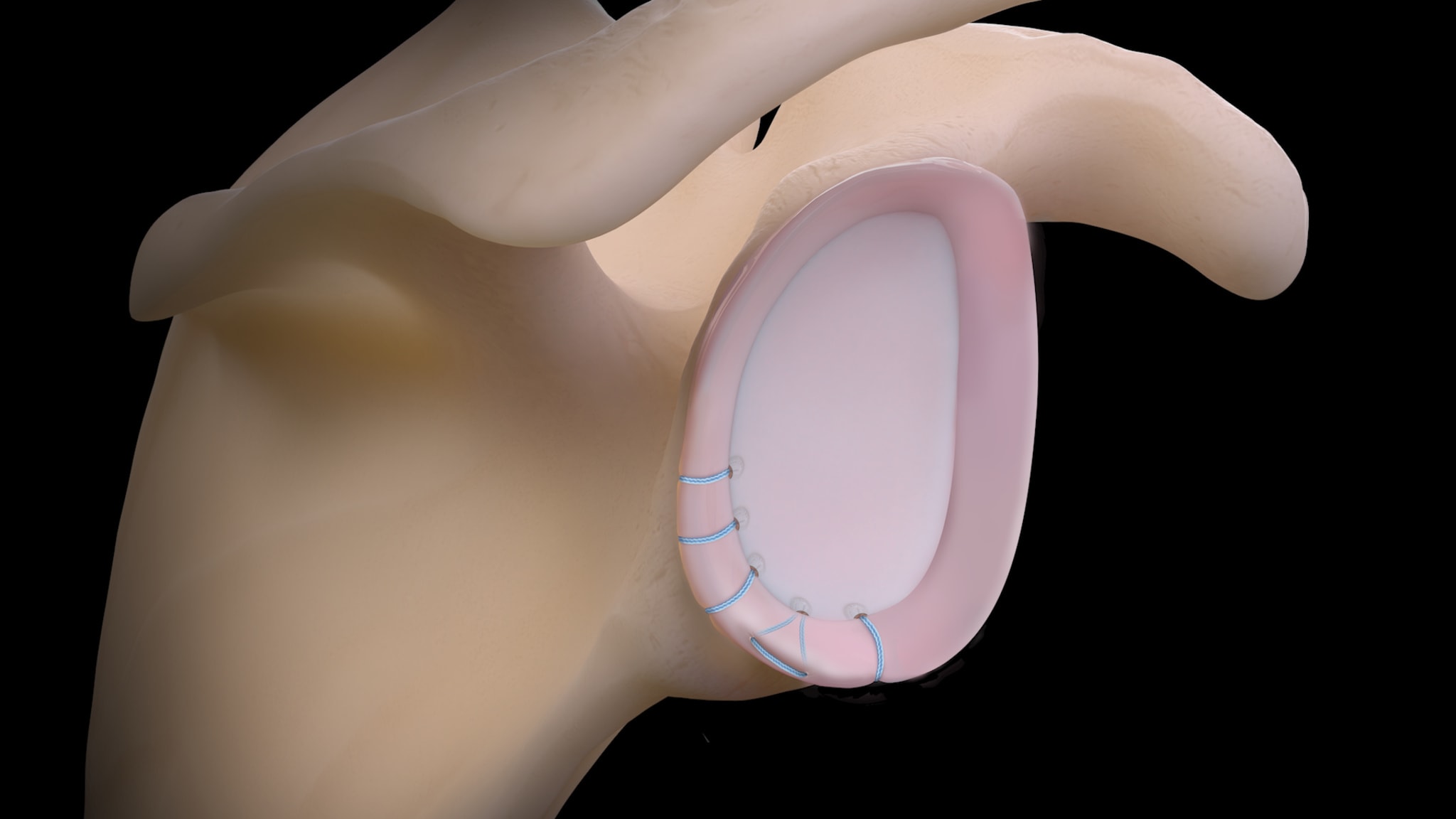 Re-Live Surgical Technique: Posterior Labral Tear Repair With Tensionable Knotless 1.8 FiberTak® Soft Anchors