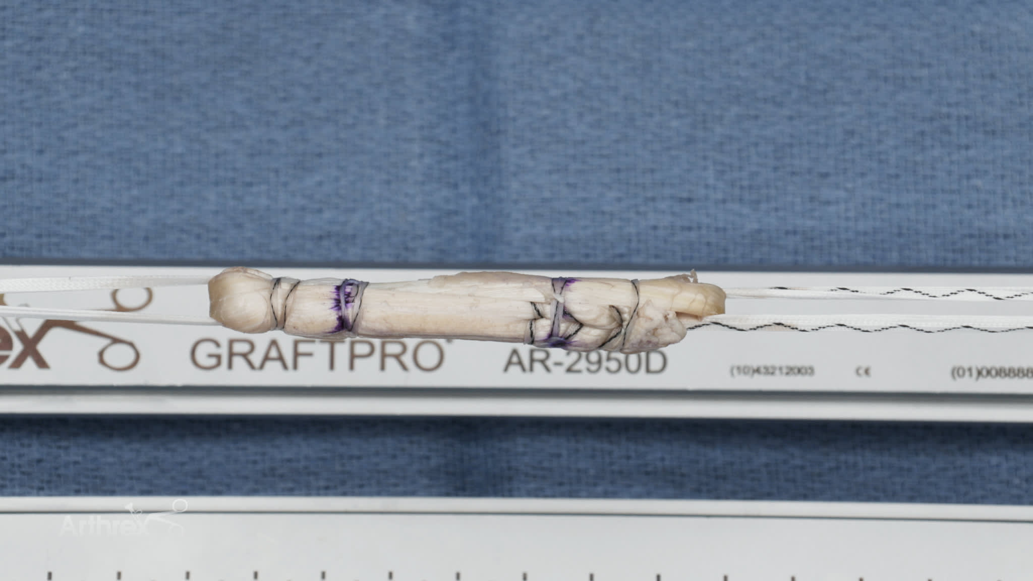 Graft Preparation Using the GraftLink® Technique With the ACL TightRope® II Implant and SutureTape