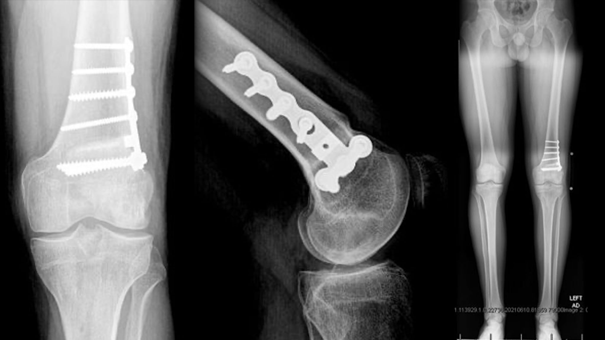Lateral Meniscal Allograft Transplantation With Distal Femoral Osteotomy and Fresh Osteochondral Allograft Transplantation