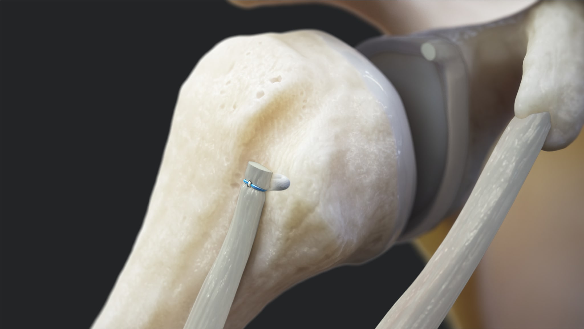 Knotless FiberTak® Biceps Implant System for Proximal Biceps Tenodesis