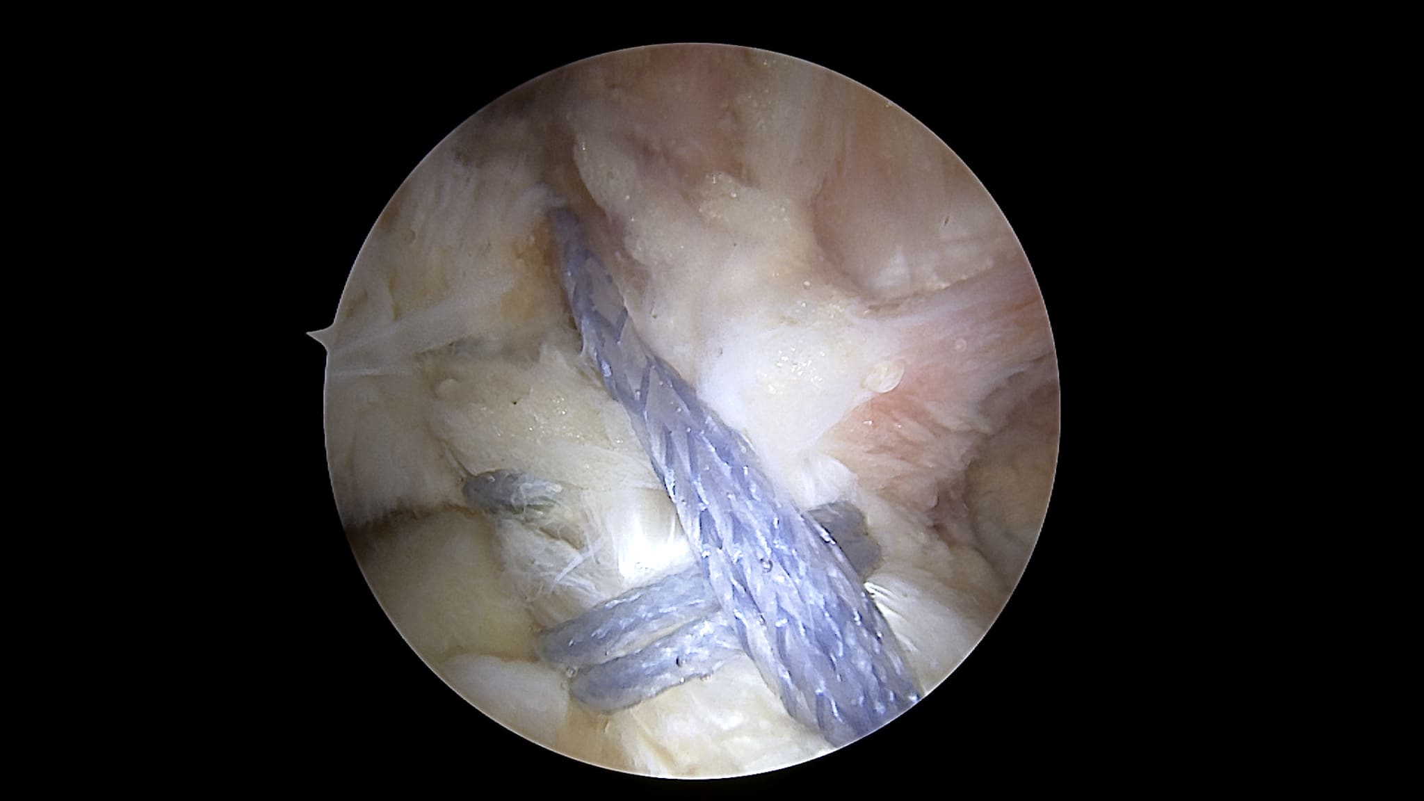 ACL Preservation Using the ACL Repair TightRope® Implant and FiberRing™ Sutures Summary 