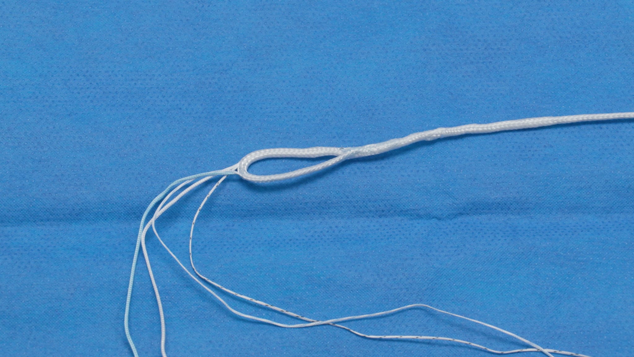 Meniscal Root Repair Using the SutureLoc™ Implant