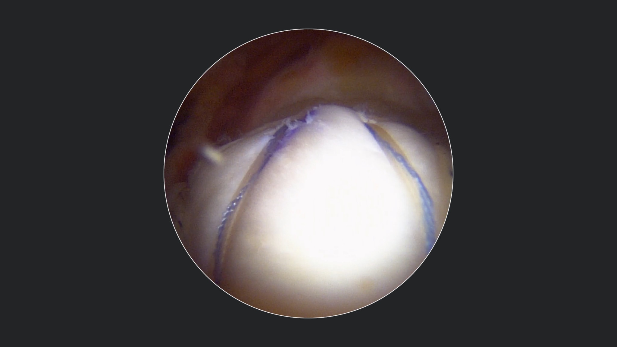Biologic Tuberoplasty for Irreparable Rotator Cuff Tears