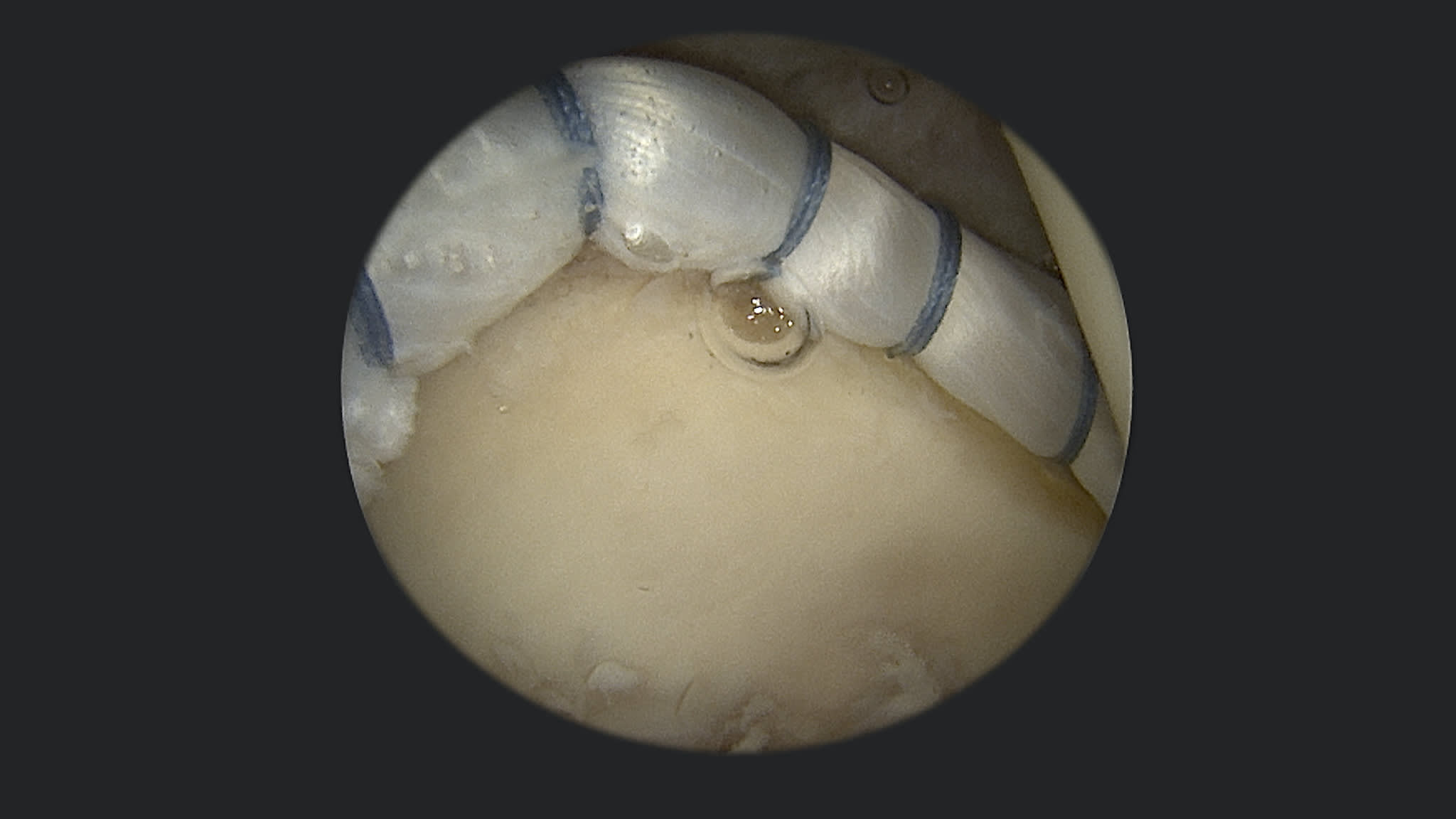 Labral Reconstruction With Graft Pull-Through Method Using Knotless 1.8 Hip FiberTak® Anchors