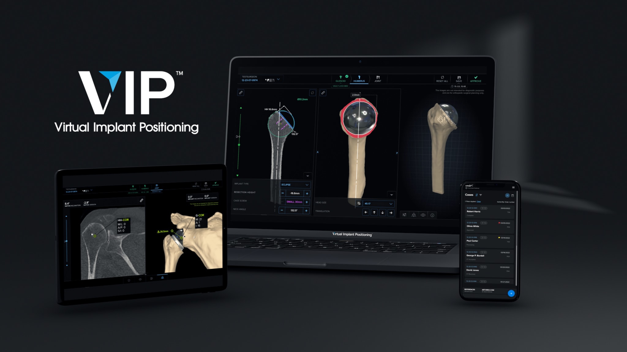 Now Available in the VIP™ Preoperative Planning System: Humeral Planning