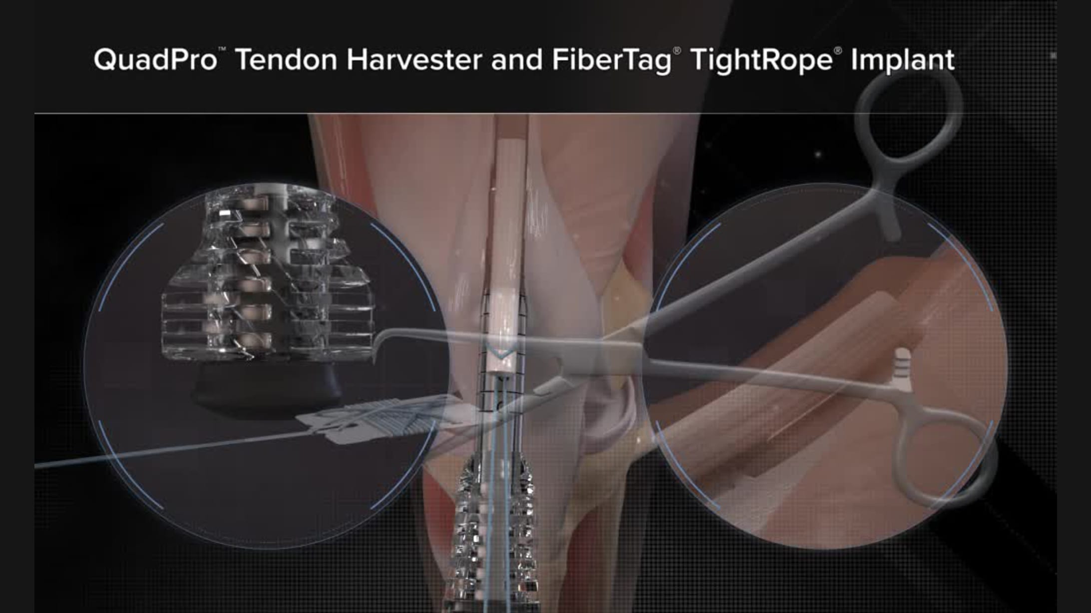QuadPro™ Tendon Harvester and FiberTag® TightRope® Implant