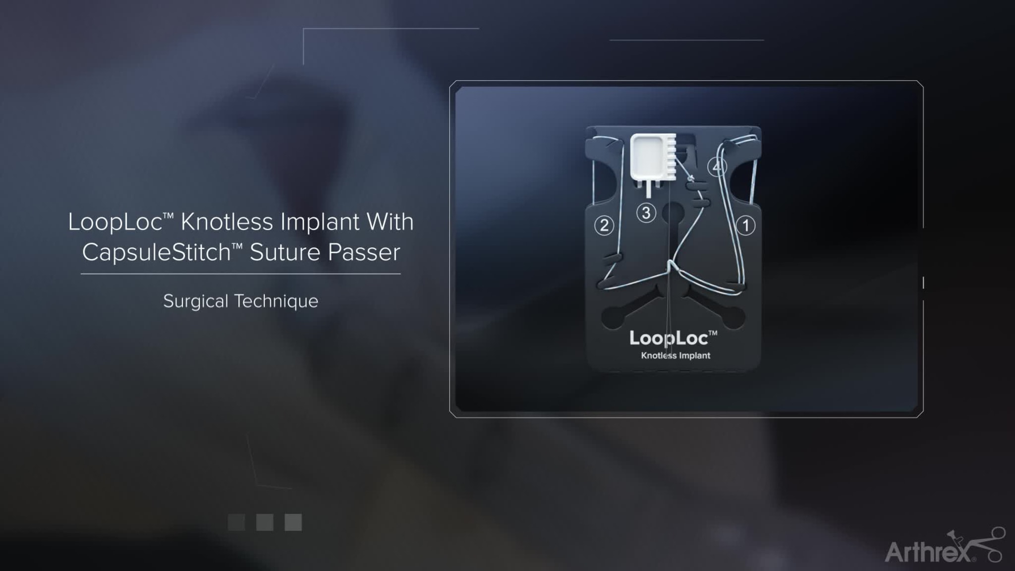 Hip Capsular Closure Using LoopLoc™ Knotless Implant