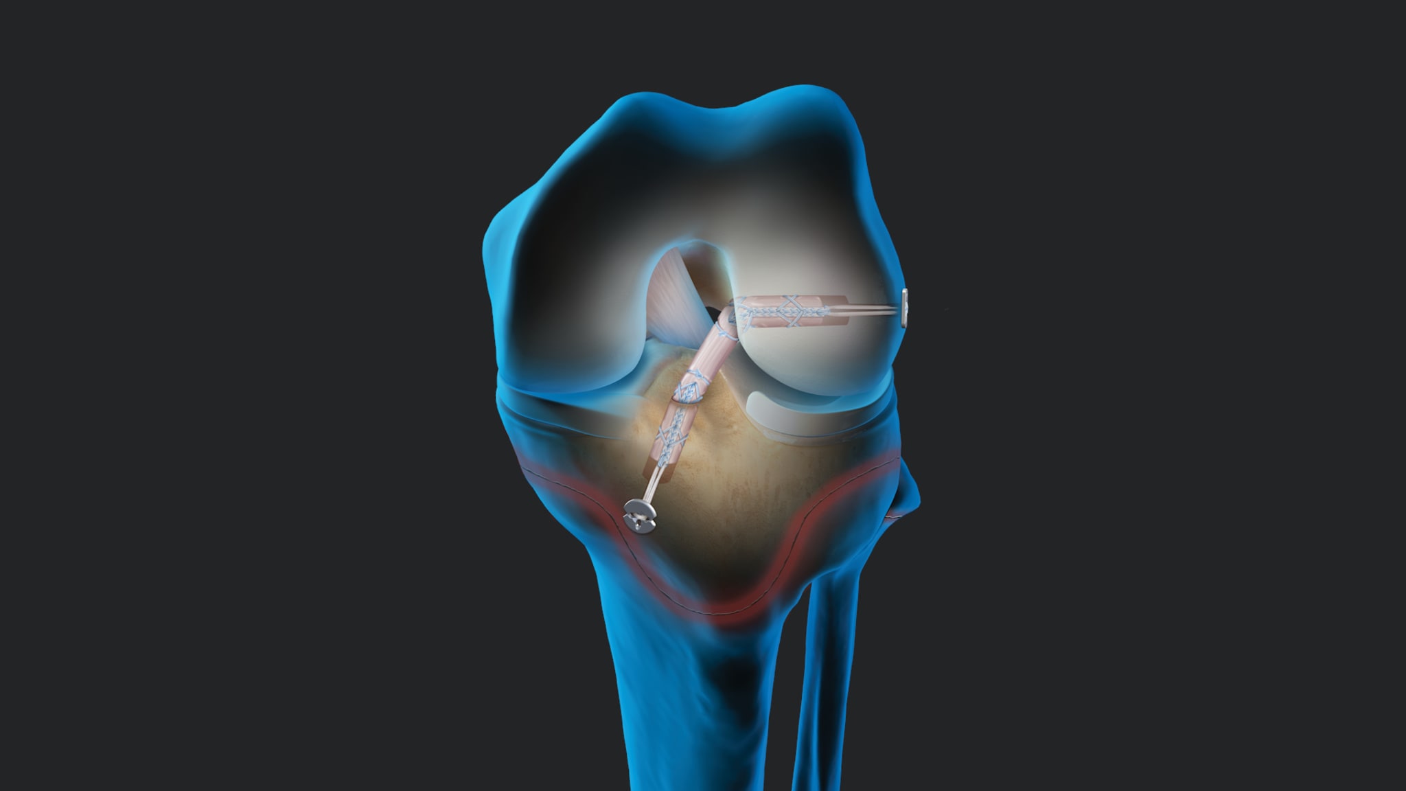 All-Inside, All-Epiphyseal QuadLink™ ACLR: FiberTag® TightRope® II Implant and Pediatric Guides