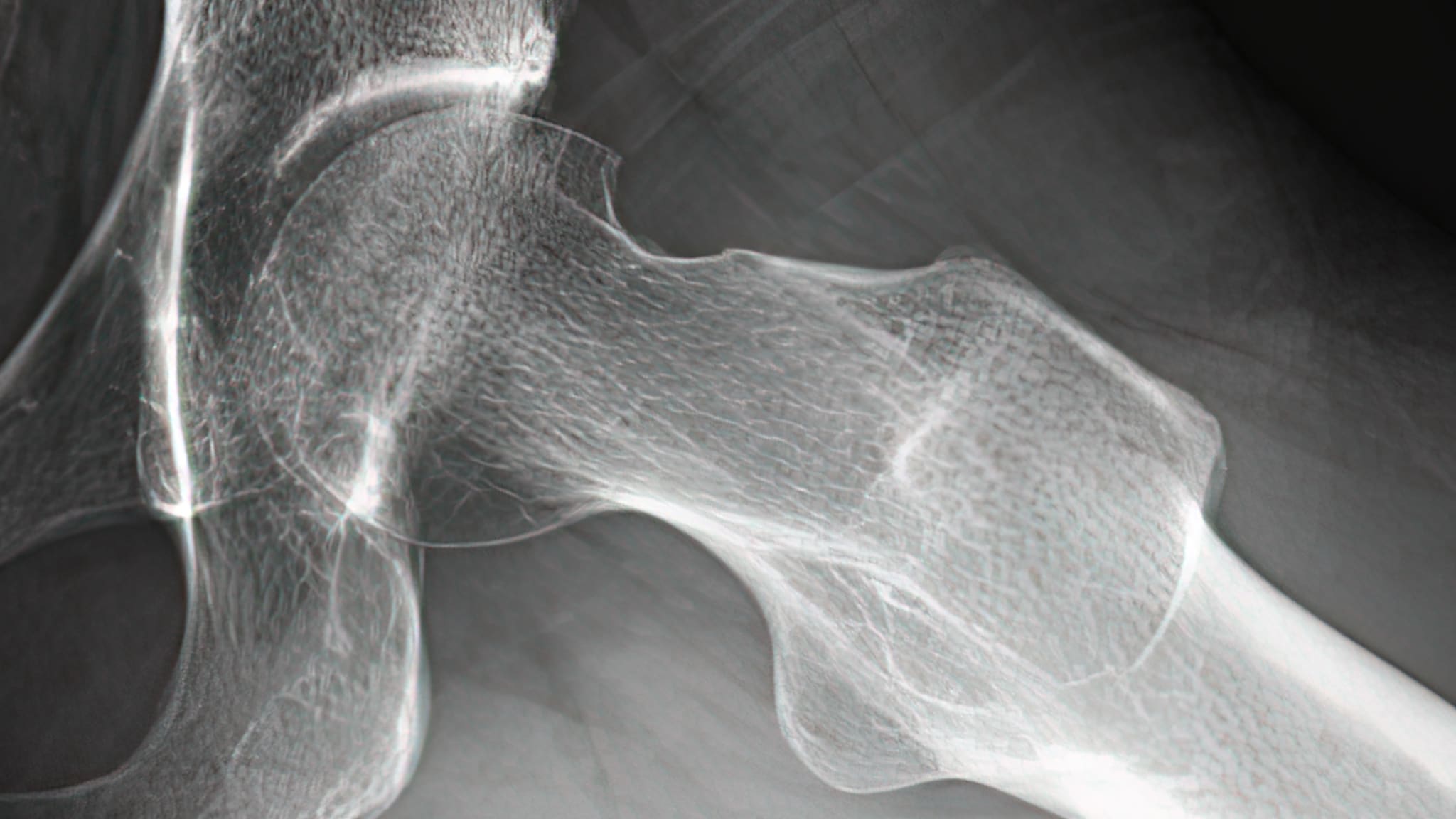 Revision Osteochondroplasty for an Overresected Femoral Neck