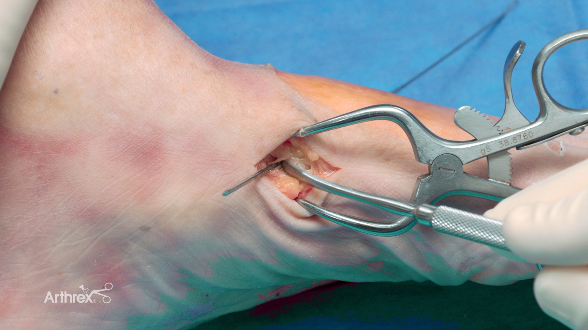 Flexible Fixation Solutions for Treating Lisfranc Injuries