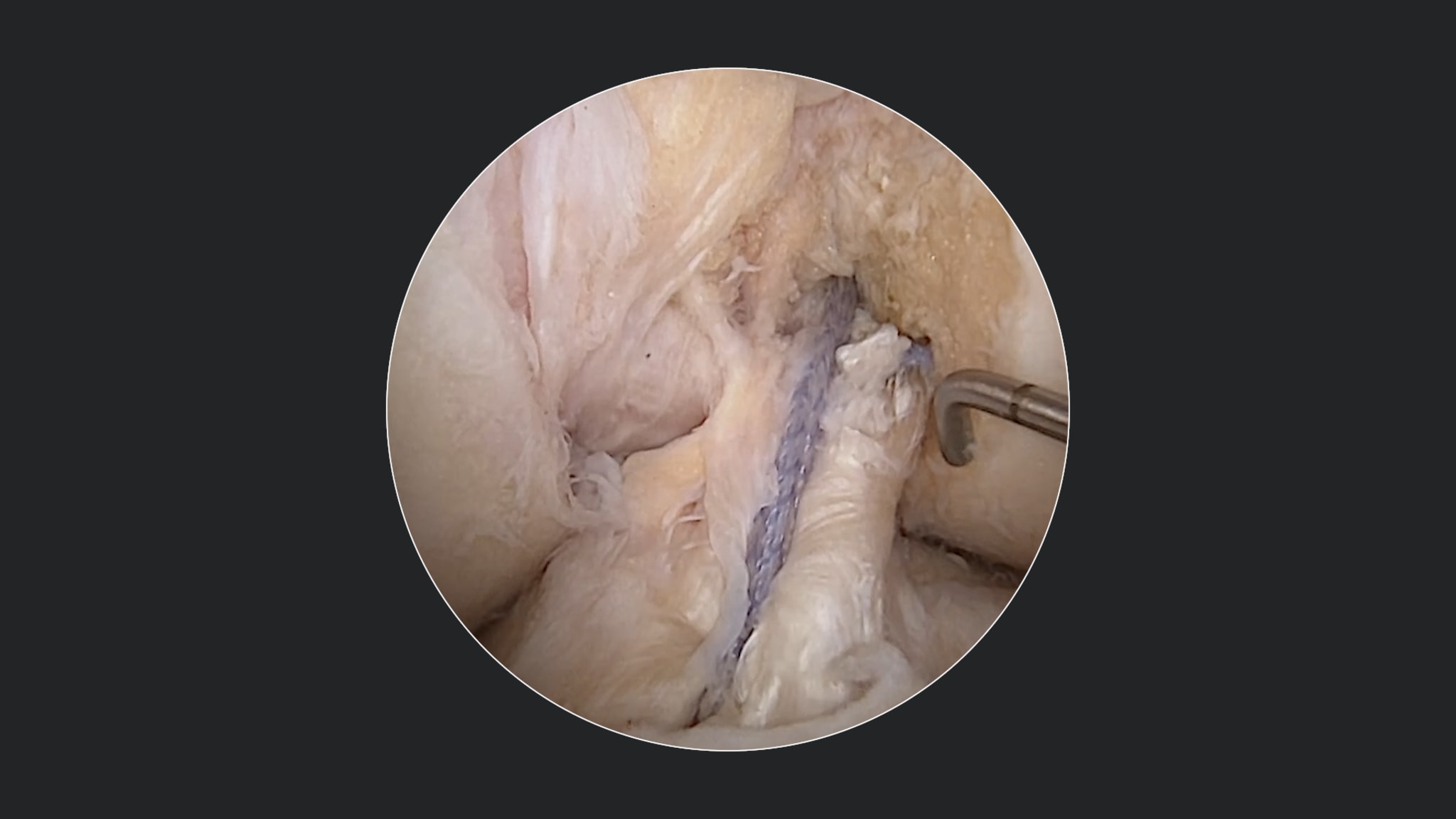 Double-Bundle ACL Primary Repair Using Dual ACL Repair TightRope® Implants and FiberRing™ Sutures