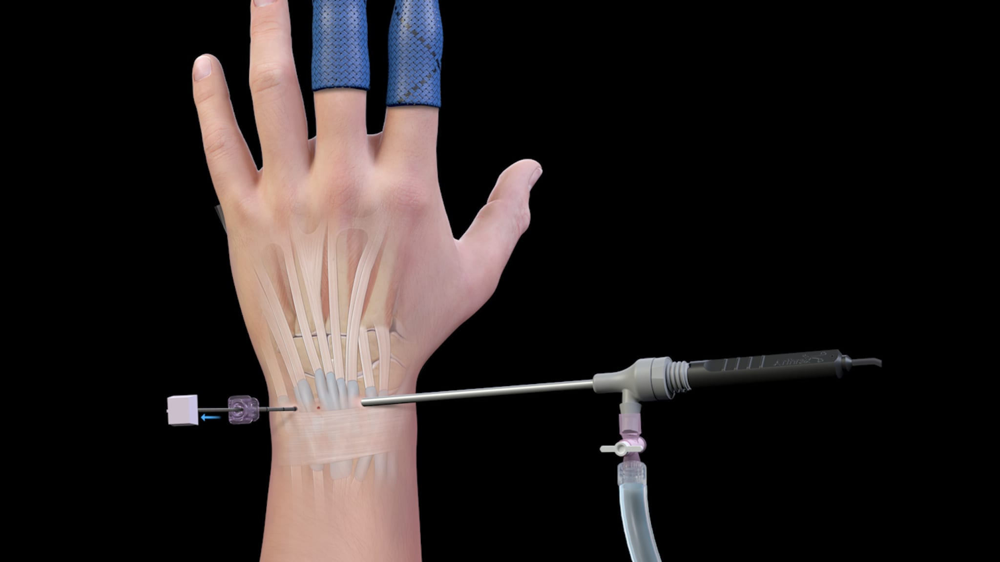 NanoScopic™ Thumb CMC and Finger Joint Arthroscopy